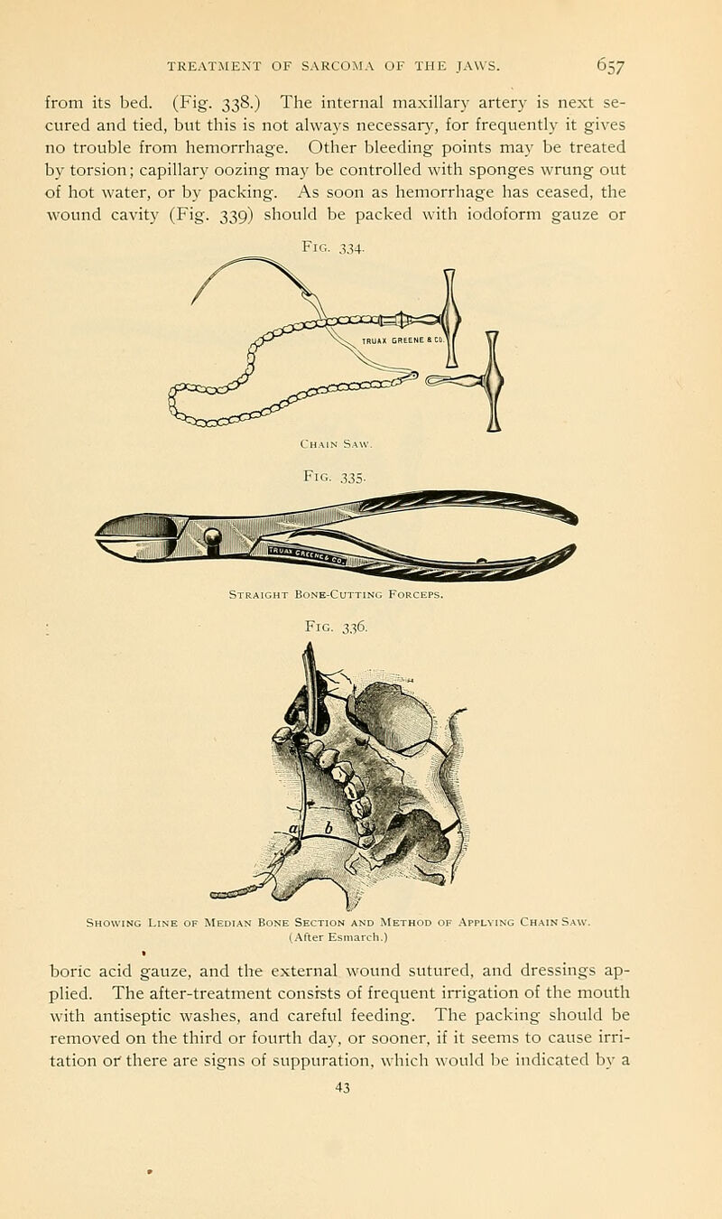 from its bed. (Fig. 338.) The internal maxillary artery is next se- cured and tied, but this is not always necessaiy, for frequently it gives no trouble from hemorrhage. Other bleeding points may be treated by torsion; capillary oozing may be controlled with sponges wrung out of hot water, or by packing. As soon as hemorrhage has ceased, the wound cavity (Fig. 339) should be packed with iodoform gauze or Fig. 334. Straight Bone-Cutting Forceps. Fig. 336. Showing Line of Median Bone Section and Method of Applying Chain Saw. (After Esmarch.) boric acid gauze, and the external wound sutured, and dressings ap- plied. The after-treatment consists of frequent irrigation of the mouth with antiseptic washes, and careful feeding. The packing should be removed on the third or fourth day, or sooner, if it seems to cause irri- tation or there are signs of suppuration, which would be indicated by a 43