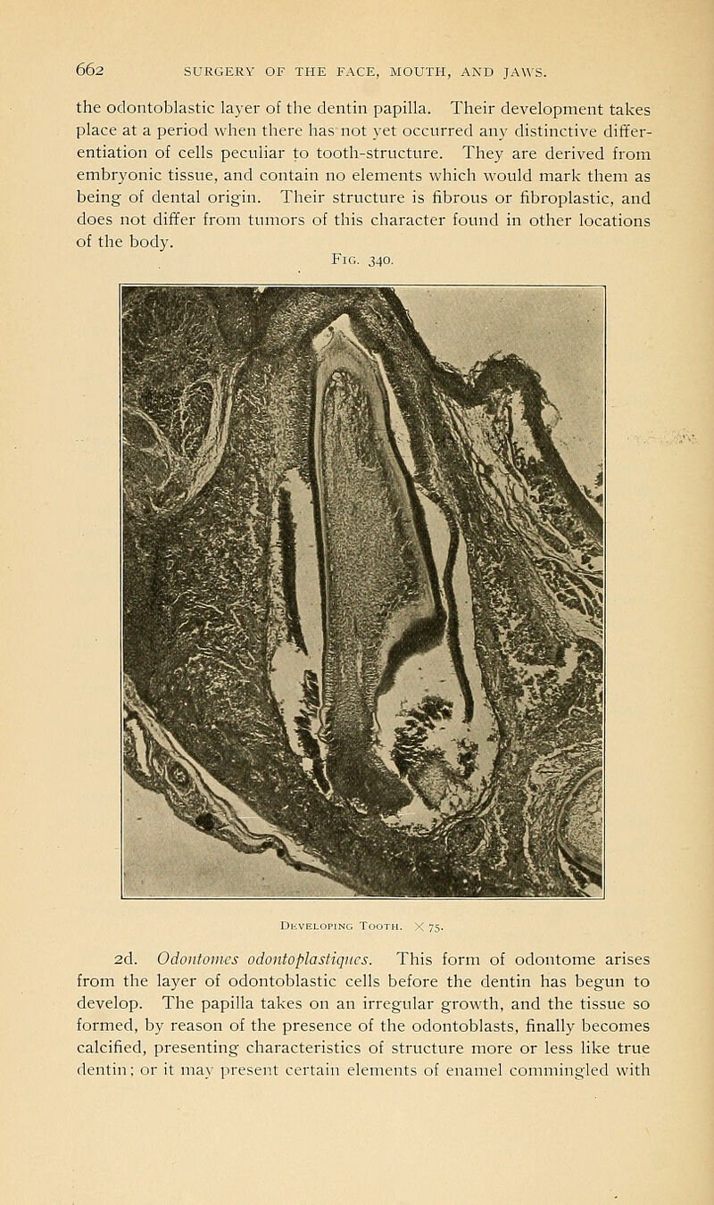 the odontoblastic layer of the dentin papilla. Their development takes place at a period when there has'not yet occurred any distinctive differ- entiation of cells peculiar to tooth-structure. They are derived from embryonic tissue, and contain no elements which would mark them as being of dental origin. Their structure is fibrous or fibroplastic, and does not differ from tumors of this character found in other locations of the body. Fig. 340. 2d. Odontoiiws odontoplastiqucs. This form of odontome arises from the layer of odontoblastic cells before the dentin has begun to develop. The papilla takes on an irregular growth, and the tissue so formed, by reason of the presence of the odontoblasts, finally becomes calcified, presenting characteristics of structure more or less like true dentin: or it may present certain elements of enamel commingled with