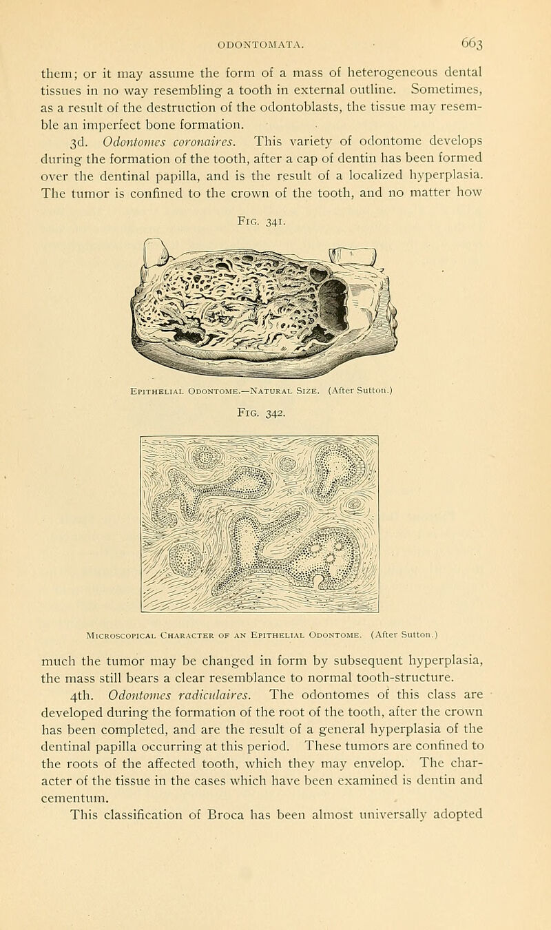 them; or it may assume the form of a mass of heterogeneous dental tissues in no way resembling a tooth in external outline. Sometimes, as a result of the destruction of the odontoblasts, the tissue may resem- ble an imperfect bone formation. 3d. Odontomas coronaires. This variety of odontome develops during the formation of the tooth, after a cap of dentin has been formed over the dentinal papilla, and is the result of a localized hyperplasia. The tumor is confined to the crown of the tooth, and no matter how Fig. 341. Epithelial Odontome.—Natural Size. (After Sutton.) Fig. 342. hfJi/ Character of an Epithelial Odontome. (After Sutton.) much the tumor may be changed in form by subsequent hyperplasia, the mass still bears a clear resemblance to normal tooth-structure. 4th. Odontomes radiculaires. The odontomes of this class are developed during the formation of the root of the tooth, after the crown has been completed, and are the result of a general hyperplasia of the dentinal papilla occurring at this period. These tumors are confined to the roots of the afifected tooth, which they may envelop. The char- acter of the tissue in the cases which have been examined is dentin and cementum. This classification of Broca has been almost universally adopted