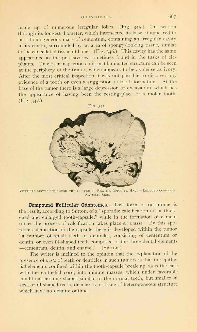 made up of numerous irregular .lobes. (Fig. 345.) On section through its longest diameter, which intersected its base, it appeared to be a homogeneous mass of cementum, containing an irregular cavity in its center, surrounded by an area of spongy-looking tissue, similar to the cancellated tissue of bone. (Fig. 346.) This cavity has the same appearance as the pus-cavities sometimes found in the tusks of ele- phants. On closer inspection a distinct laminated structure can be seen at the periphery of the tumor, which appears to be as dense as ivory. After the most critical inspection it was not possible to discover any evidence of a tooth or even a suggestion of tooth-formation. At the base of the tumor there is a large depression or excavation, which has the appearance of having been the resting-place of a molar tooth. (Fig. 347-) Fig. 347. Vertical Section through the Center of Fig. 345, Opposite Half.—Reduced One-half Compound Follicular Odontomes.—This form of odontome is the result, according to Sutton, of a sporadic calcification of the thick- ened and enlarged tooth-capsule, while in the formation of cemen- tomes the process of calcification takes place en masse. By this spo- radic calcification of the capsule there is developed within the tumor a number of small teeth or denticles, consisting of cementum or dentin, or even ill-shaped teeth composed of the three dental elements —cementum, dentin, and enamel. (Sutton.) The writer is inclined to the opinion that the explanation of the presence of nests of teeth or denticles in such tumors is that the epithe- lial elements confined within the tooth-capsule break up, as is the case with the epithelial cord, into minute masses, which under favorable conditions assume shapes similar to the normal teeth, but smaller in size, or ill-shaped teeth, or masses of tissue of heterogeneous structure which have no definite outline.