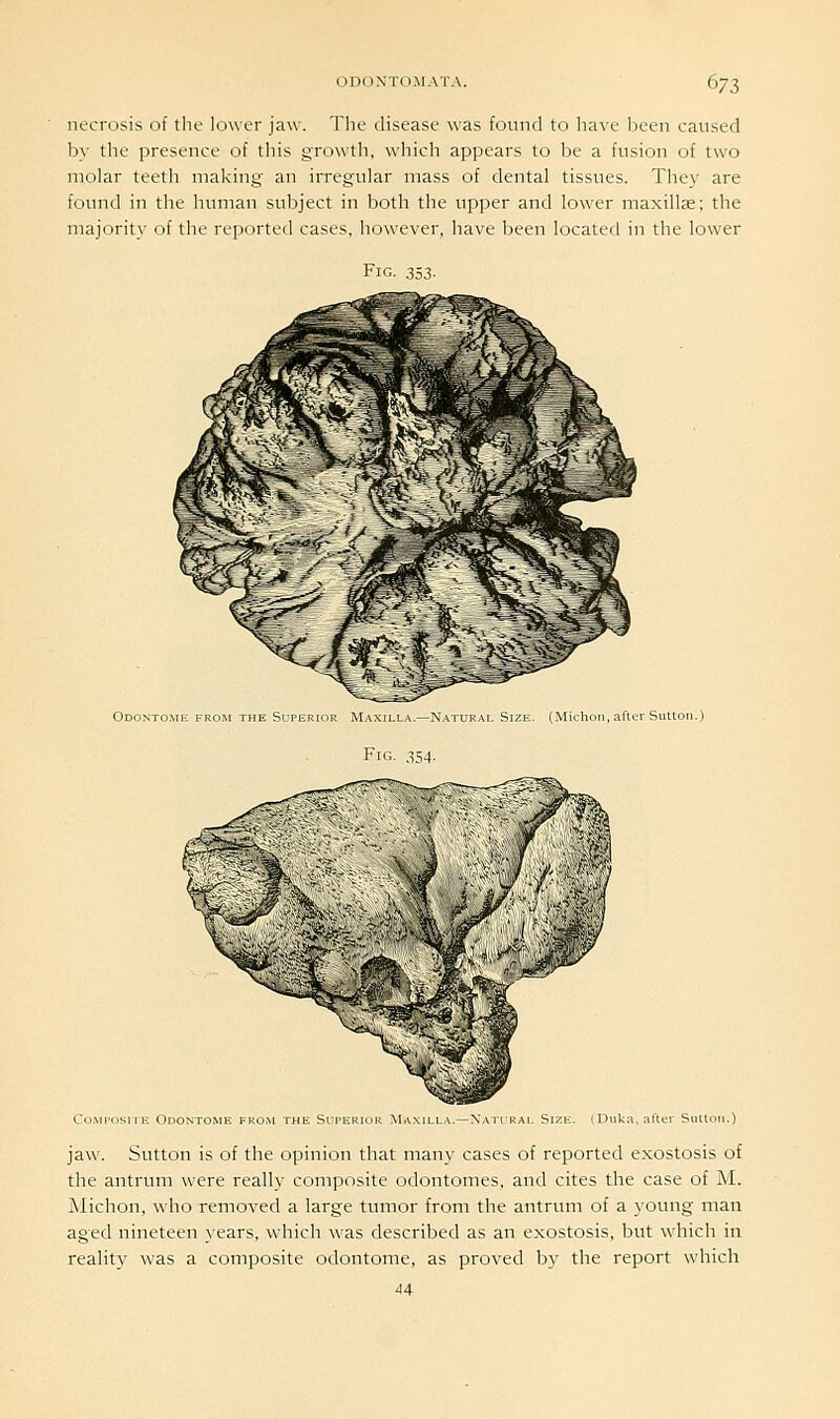 necrosis of the lower jaw. The disease was found to have Ijeen caused by the presence of this growtli, which appears to be a fusion of two molar teeth making an irregular mass of dental tissues. They are found in the human subject in both the upper and lower maxillae; the majority of the reported cases, however, have been located in the lower jaw. Sutton is of the opinion that many cases of reported exostosis of the antrum were really composite odontomes, and cites the case of M. Alichon, who removed a large tumor from the antrum of a young man aged nineteen years, which was described as an exostosis, but which in reality was a composite odontome, as proved by the report which 44