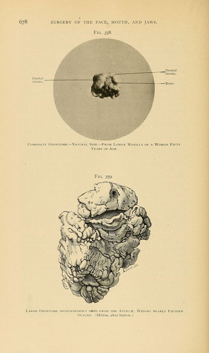 Fig. 358. Composite Odontomk.—Natural Size.—From Lower Ma Years of Age. of a Woman Fifty Fig. 359- Large Odontome spontaneously shed from the Antrum; Weight nearly Fifteen Ounces. (Hilton, after Sutton.)