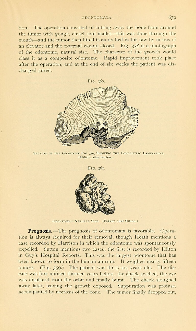 tion. The operation consisted of cutting away the bone from around the tumor with gouge, chisel, and mallet—this was done through the mouth—and the tumor then lifted from its bed in the jaw by means of an elevator and the external wound closed. Fig. 358 is a photograph of the odontome, natural size. The character of the growth would class it as a composite odontome. Rapid improvement took place after the operation, and at the end of six weeks the patient was dis- charged cured. Fig. 360. Section of the O Fig. 359, Showing the Concentric Lamination. (Hilton, after Sutton.) Fig. 361. Odontome.—Natural Size. (Parker, after Sutton.) Prognosis.—The prognosis of odontomata is favorable. Opera- tion is always required for their removal, though Heath mentions a case recorded by Harrison in which the odontome was spontaneously expelled. Sutton mentions two cases; the first is recorded by Hilton in Guy's Hospital Reports. This was the largest odontome that has been known to form in the human antrum. It weighed nearly fifteen ounces. (Fig. 359.) The patient was thirty-six years old. The dis- ease was first noticed thirteen years before: the cheek swelled, the eye was displaced from the orbit and finally burst. The cheek sloughed away later, leaving the growth exposed. Suppuration was profuse, accompanied by necrosis of the bone. The tumor finally dropped out,