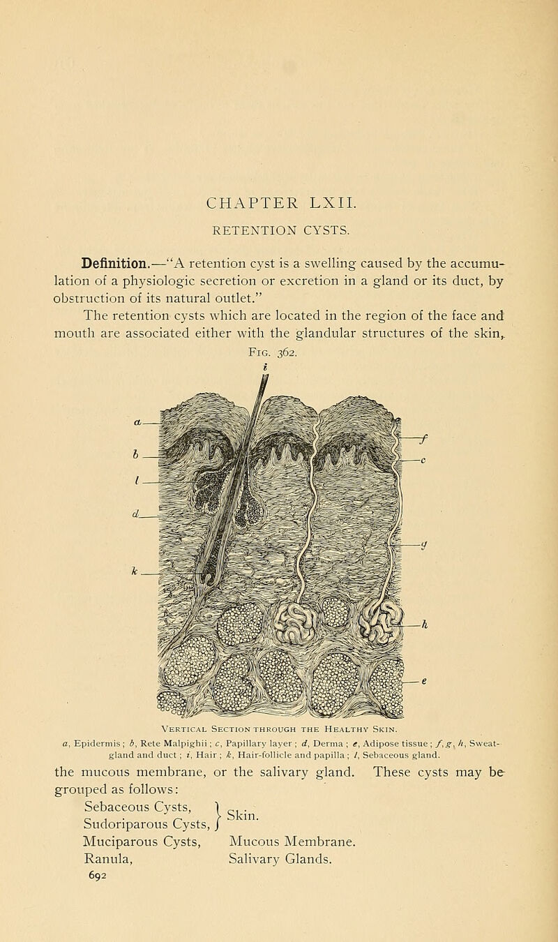 CHAPTER LXII. RETENTION CYSTS. Definition.-—A retention cyst is a swelling caused by the accumu- lation of a physiologic secretion or excretion in a gland or its duct, by obstruction of its natural outlet. The retention cysts which are located in the region of the face and mouth are associated either with the glandular structures of the skin^ Fig. 362. Vertical Section through the Healthy Skin a, Epidermis ; b, Rete Malpigiiii; c, Papillary layer ; d, Derma ; e, Adipose tissue ; f,g, A, Sweat- gland and duct; i. Hair ; k^ Hair-follicle and papilla; /, Sebaceous gland. the mucous membrane, or the salivary gland. These cysts may be- grouped as follows: Sebaceous Cysts, I „ . Sudoriparous Cysts, J Muciparous Cysts, Mucous Membrane. Ranula, Salivary Glands.