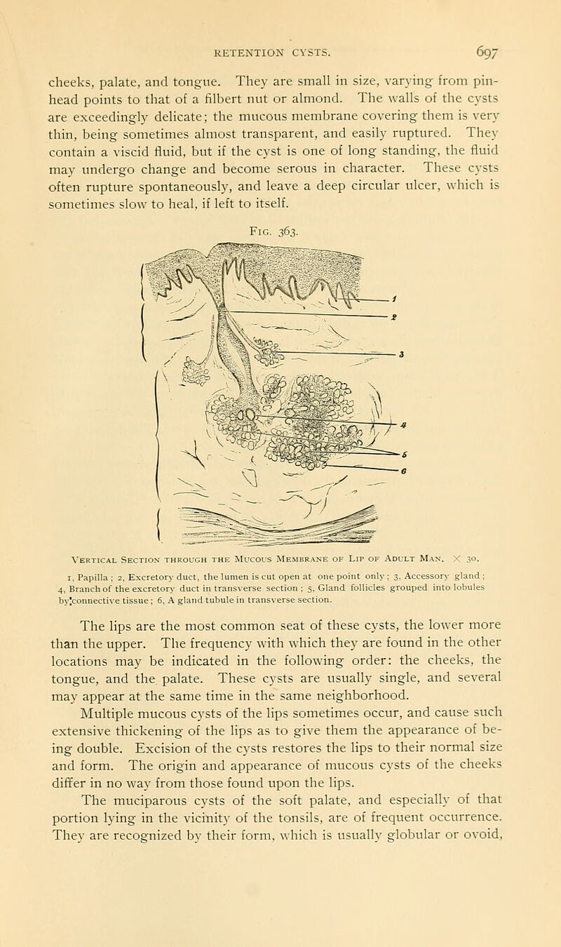 cheeks, palate, and tongue. They are small in size, varying from pin- head points to that of a filbert nut or almond. The walls of the cysts are exceedingly delicate; the mucous membrane covering them is very thin, being sometimes almost transparent, and easily ruptured. They contain a viscid fluid, but if the cyst is one of long standing, the fluid may undergo change and become serous in character. These cysts often rupture spontaneously, and leave a deep circular ulcer, which is sometimes slow to heal, if left to itself. Fir i6^ , Section through Mucous Membrane of Lip of Adult Man. X 30. : 3, Accessor)- gland ; grouped into lobules I, Papilla ; 2, Excretory duct, the lumen is cut open at one point onl 4, Branch of the excretory duct in trans\-erse section ; 5, Gland follicle byJconnecti\-e tissue ; 6, A gland tubule in transverse section. The lips are the most common seat of these cysts, the lower more than the upper. The frequency with which they are found in the other locations may be indicated in the following order: the cheeks, the tongue, and the palate. These cysts are usually single, and several may appear at the same time in the same neighborhood. Multiple mucous cysts of the lips sometimes occur, and cause such extensive thickening of the lips as to give them the appearance of be- ing double. Excision of the cysts restores the lips to their normal size and form. The origin and appearance of mucous cysts of the cheeks differ in no way from those found upon the lips. The muciparous cysts of the soft palate, and especially of that portion lying in the vicinity of the tonsils, are of frequent occurrence. Thev are recognized bv their form, which is usually globular or ovoid.