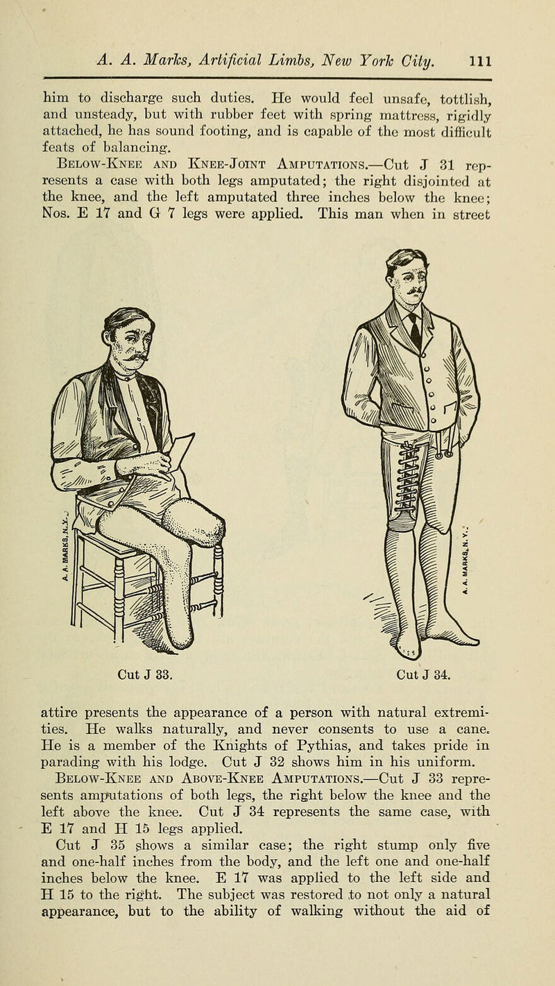 him to discharge such duties. He would feel unsafe, tottlish, and unsteady, but with rubber feet with spring mattress, rigidly attached, he has sound footing, and is capable of the most difficult feats of balancing. Below-Knee and Knee-Joint Amputations.—Cut J 31 rep- resents a case with both legs amputated; the right disjointed at the knee, and the left amputated three inches below the knee; Nos. E 17 and G 7 legs were applied. This man when in street Cut J 33. Cut J 34. attire presents the appearance of a person with natural extremi- ties. He walks naturally, and never consents to use a cane. He is a member of the Knights of Pythias, and takes pride in parading with his lodge. Cut J 32 shows him in his uniform. Below-Knee and Above-Knee Amputations.—Cut J 33 repre- sents ampTitations of both legs, the right below the knee and the left above the knee. Cut J 34 represents the same case, with E 17 and H 15 legs applied. Cut J 35 ^hows a similar case; the right stump only five and one-half inches from the body, and the left one and one-half inches below the knee. E 17 was applied to the left side and H 15 to the right. The subject was restored to not only a natural appearance, but to the ability of walking without the aid of