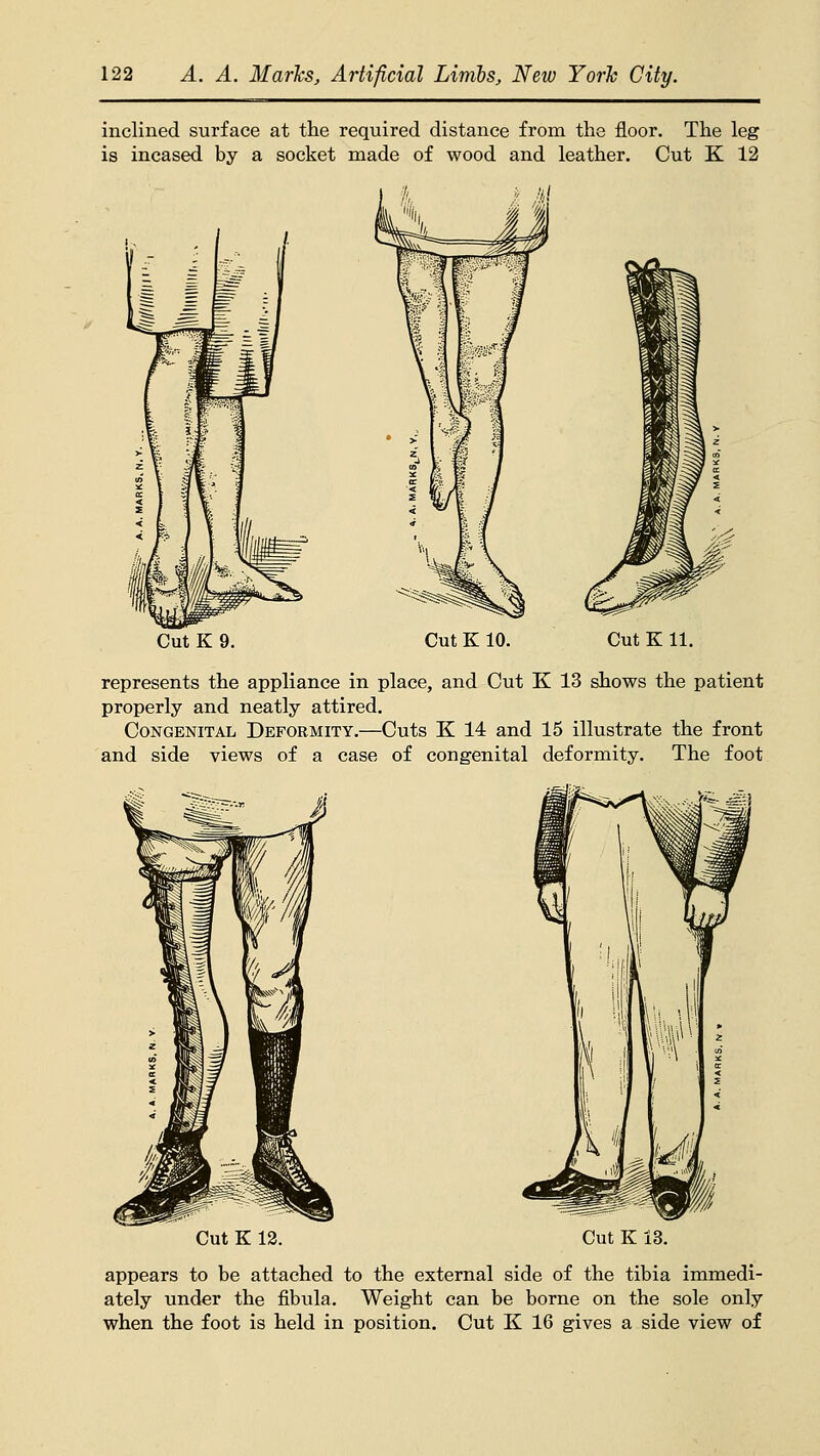 inclined surface at the required distance from the floor. The leg is incased by a socket made of wood and leather. Cut K 12 Cut K 9. Cut K 10. Cut K 11. represents the appliance in place, and Cut K 13 shows the patient properly and neatly attired. Congenital Deformity.—Cuts K 14 and 15 illustrate the front and side views of a case of congenital deformity. The foot Cut K 13. Cut K 13. appears to be attached to the external side of the tibia immedi- ately under the fibula. Weight can be borne on the sole only when the foot is held in position. Cut K 16 gives a side view of