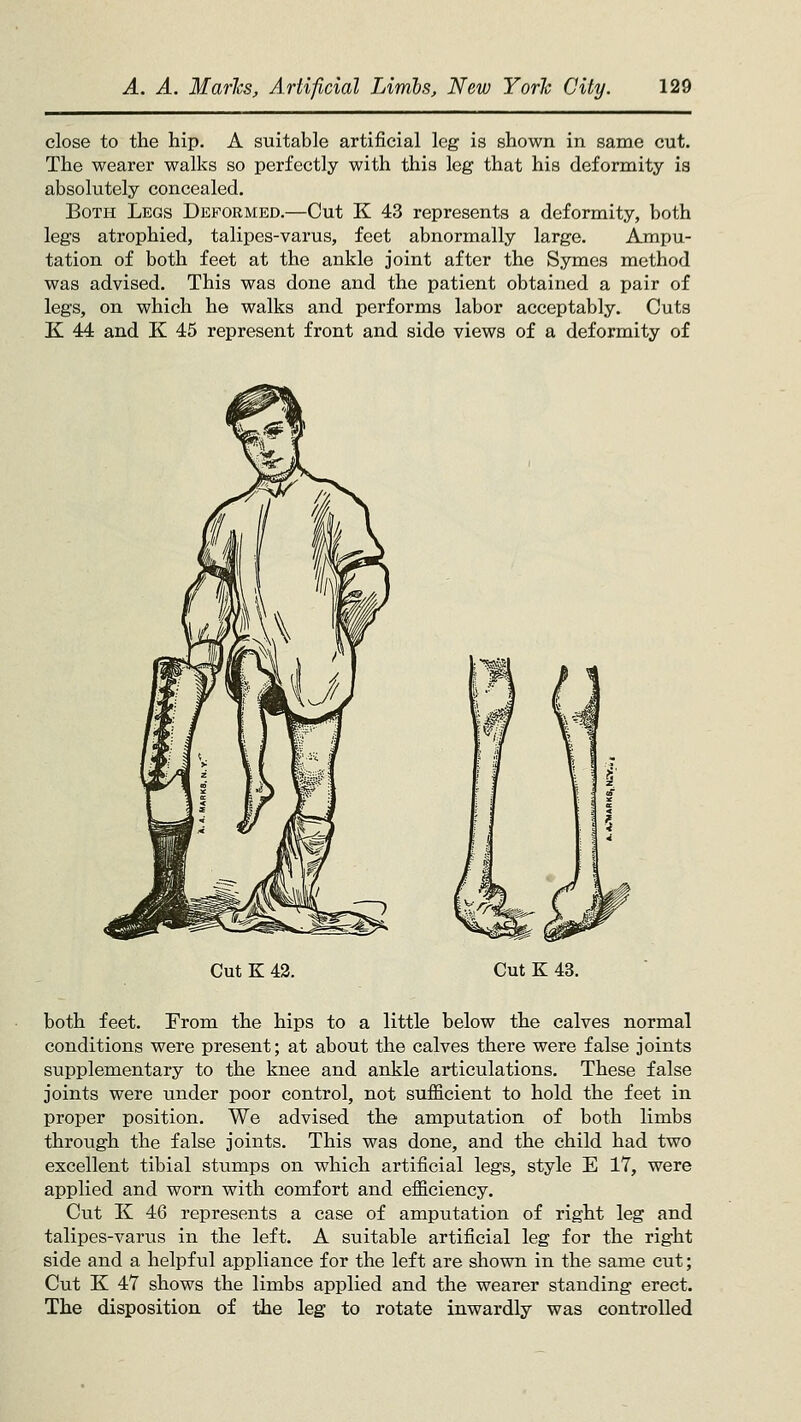 close to the hip. A suitable artificial leg is shown in same cut. The wearer walks so perfectly with this leg that his deformity is absolutely concealed. Both Legs Deformed.—Cut K 43 represents a deformity, both legs atrophied, talipes-varus, feet abnormally large. Ampu- tation of both feet at the ankle joint after the Symes method was advised. This was done and the patient obtained a pair of legs, on which he walks and performs labor acceptably. Cuts K 44 and K 45 represent front and side views of a deformity of Cut K 43. Cut K 43. both feet. From the hips to a little below the calves normal conditions were present; at about the calves there were false joints supplementary to the knee and ankle articulations. These false joints were under poor control, not sufficient to hold the feet in proper position. We advised the amputation of both limbs through the false joints. This was done, and the child had two excellent tibial stumps on which artificial legs, style E 17, were applied and worn with comfort and efficiency. Cut K 46 represents a case of amputation of right leg and talipes-varus in the left. A suitable artificial leg for the right side and a helpful appliance for the left are shown in the same cut; Cut K 47 shows the limbs applied and the wearer standing erect. The disposition of the leg to rotate inwardly was controlled