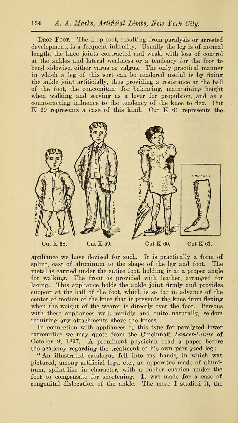 Drop Foot.—The drop foot, resulting from paralysis or arrested development, is a frequent infirmity. Usually the leg is of normal length, the knee joints contracted and weak, with loss of control at the ankles and lateral weakness or a tendency for the foot to bend sidewise, either varus or valgus. The only practical manner in which a leg of this sort can be rendered useful is by fixing the ankle joint artificially, thus providing a resistance at the ball of the foot, the concomitant for balancing, maintaining height when walking and serving as a lever for propulsion, and as a counteracting influence to the tendency of the knee to flex. Cut K 60 represents a case of this kind. Cut K 61 represents the Cut K 58. Cut K 59. Cut K 60. Cut K 61. appliance we have devised for such. It is practically a form of splint, cast of aluminum to the shape of the leg and foot. The metal is carried under the entire foot, holding it at a proper angle for walking. The front is provided with leather, arranged for lacing. This appliance holds the ankle joint firmly and provides support at the ball of the foot, which is so far in advance of the center of motion of the knee that it prevents the knee from flexing when the weight of the wearer is directly over the foot. Persons with these appliances walk rapidly and quite naturally, seldom requiring any attachments above the knees. In connection with appliances of this type for paralyzed lower extremities we may quote from the Cincinnati Lancet-Clinic of October 9, 1897. A prominent physician read a paper before the academy regarding the treatment of his own paralyzed leg: An illustrated catalogue fell into my hands, in which was pictured, among artificial legs, etc., an apparatus made of alumi- num, splint-like in character, with a rubber cushion under the foot to compensate for shortening. It was made for a case of congenital dislocation of the ankle. The more I studied it, the