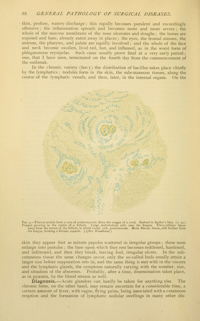 thin, profuse, watery discharge; this rapidly becomes ijurulent and exceedingly offensive; the inflammation spreads and becomes more and more severe; the whole of the mucous membrane of the nose ulcerates and sloughs; the bones are exposed and bare, already eaten away in places; the eyes, the frontal sinuses, the antrum, the pharynx, and palate are rapidly involved ; and the whole of the face and neck become swollen, livid red, hot, and inflamed, as in the worst form of phlegmonous erysipelas. Such cases usually prove fatal at a very early period ; one, that I have seen, terminated on the fourth day from the commencement of the outbreak. In the chronic variety (farcy) the distribution of bacillus takes place chiefly by the lymphatics; nodules form in the skin, the subcutaneous tissues, along the course of the lymphatic vessels, and then, later, in the internal organs. On the :^N^^ Fig. 9.—Fibrous nodule from a case of actinomycosis (from the tongue of a cow). Stained in Spiller's blue. (X 50.) f^mgus growing in the centre of a follicle. Large endothelioid cells near the fungus. Fibro-cellular tissue away from the centre of the follicle, in which round cells predominate. More fibrous tissue, still further from the fungus, forming a fibrous capsule. (A/ter IVoodhead.) skin they appear first as minute papules scattered in irregular groups ; these soon enlarge into pustules ; the base upon which they rest becomes reddened, hardened, and infiltrated, and then they break, leaving foul, irregular ulcers. In the sub- cutaneous tissue the same changes occur, only the so-called buds usually attain a larger size before supjniration sets in, and the same thing is met with in the viscera and the lymphatic glands, the symptoms naturally varying with the number, size, and situation of the abscesses. Probably, after a time, dissemination takes place, as in pyaemia, by the blood-stream as well. Diagnosis.—Acute glanders can hardly be taken for anything else. The chronic form, on the other hand, may remain uncertain for a considerable time, a certain amount of fever, with vague, flying pains, being associated with a cutaneous eruption and the formation of lymphatic nodular swellings in many other dis-