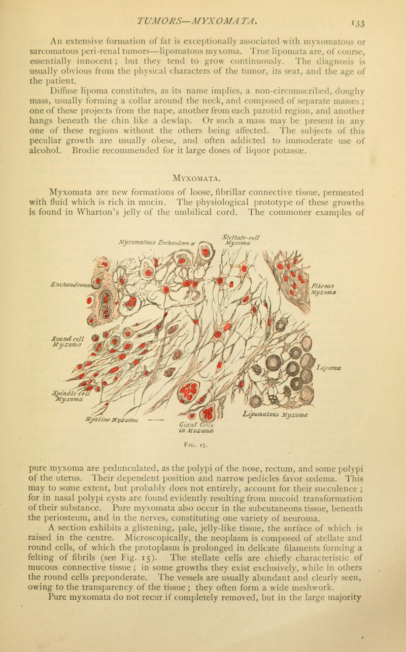TUMO RS— A/-VX OMA TA. An extensive formation of fat is exceptionally associated with myxomatous or sarcomatous peri-renal tumors—lij)omatous myxoma. True lipomata are, of course, essentially innocent; but they tend to grow continuously. The diagnosis is usually obvious from the physical characters of the tumor, its seat, and the age of the patient. Diffuse lipoma constitutes, as its name implies, a non-circinnscribed, doughy mass, usually forming a collar around the neck, and composed of separate masses ; one of these projects from the nape, another from each parotid region, and another hangs beneath the chin like a devvla]). Or such a mass may be j^resent in any one of these regions without the others being affected. I'he subjects of this peculiar growth are usually obese, and often addicted to immoderate use of alcohol. Brodie recommended for it large doses of liquor potassae. Myxomata. Myxomata are new formations of loose, fibrillar connective tissue, permeated with fluid which is rich in mucin. The physiological prototype of these growths is found in Wharton's jelly of the umbilical cord. The commoner examples of Myxomatoii.'i Enchondm^ \o ^X M_y.ioma M:4 En c/iofn/rM/itB Jiound cell Myjcoma Lijjoma ST/aline Mi/xo/na imaloiis ili/xoma Fig. is. pure myxoma are pedunculated, as the polypi of the nose, rectum, and some polypi of the uterus. Their dependent position and narrow pedicles favor oedema. This may to some extent, but probably does not entirely, account for their succulence ; for in nasal polypi cysts are found evidently resulting from mucoid transformation of their substance. Pure myxomata also occur in the subcutaneons tissue, beneath the periosteum, and in the nerves, constituting one variety of neuroma. A section exhibits a glistening, pale, jelly-like tissue, the surface of which is raised in the centre. Microscopically, the neoplasm is composed of stellate and round cells, of which the protoplasm is prolonged in delicate filaments forming a felting of fibrils (see Fig. 15). The stellate cells are chiefly characteristic of mucous connective tissue; in some growths they exist exclusively, while in others the round cells preponderate. The vessels are usually abundant and clearly seen, owing to the transparency of the tissue; they often form a wide meshwork. Pure myxomata do not recur if completely removed, but in the large majority