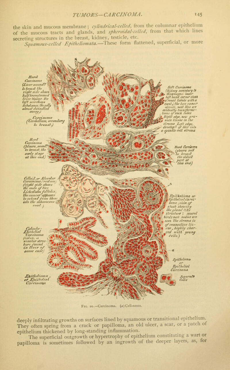 the skin ami mucous membrane ; cylindrical-cclIaU from the coUimnar epitheHum of the mucous tracts and glands, and sphcroidal-ccllcd, from that which lines secreting structures in the breast, kidnev, testicle, etc. Siiiiamous-ccUcd Epitheliomata.— '\\\(t^ form flattened, superficial, or more ffard Carcinemci ^iver sccondV ie breast the right side shows Tialftraiis/'ornicc? liver Hs'xiir. the (eff scirrhuus suhstancc. j/ircei almost {lu'imllccl Ca Lara noma \\ (Cerebellum, seconclaru \j\ ^ la breast.) '« Hard Carctnoina (Jdciirfi, seand?[ to trrenst, tJie early si age at t/n's end) dfinnl,)>r Alveolar Carcinoma /'rrcliuji fri/^/it side shous ifte ends o^ tiro Lieier/CuhnfoUidrs tlie cancer aj?/iears to extend ^roni these into the subtitticom, coat A Cu/inder - JEhithelial Carcirioniu (colon, a similar struc- ture foiiTid in h'ver it/ same case) £/tithehoma , or H/dthelinl CarcL/iij/tiii- Soft Carrijioma (Kidney secondary te (h'sopAuffas: lower left /land corner shiM a renal lobule witli a cast JI Ac lu'O caneir aliyoli. Jieil l/its a!t evidenlli/ transforma- tions of'sU4:k lubes ]iipAt edye, new gra - nitle tissue in the ilroma Left edc/e, -■ develop - of Ihis inla a spt/idle cell tlroma Hard, Carcixma Qileura sedl to breast the oldest part at lAis end) Epitkeli'oma or KpitkeJial Carxi- noma ^skin of^ cTiieA' shouinn theyland like Structure ', several birds nesl Ijodie-S are seen. The stroma is ofcrmeclii'e lis- sue, ^iyhly char- f J/^d with younq f^ cells.) ^ SpUhehoma or Epithelial Camnoma Separata Cells Fig. 20.—Carcinoma, (a) Cell-nests. deeply infiltrating growths on surfaces lined by squamous or transitional epithelmm They'often spring'from a crack or papilloma, an old ulcer, a scar, or a patch of epithelium thickened by long-standing inflammation. The superficial outgrowth or hypertrophy of epithelium constituting a wart or papilloma is sometimcb^ followed by an ingrowth of the deeper layers, as, for