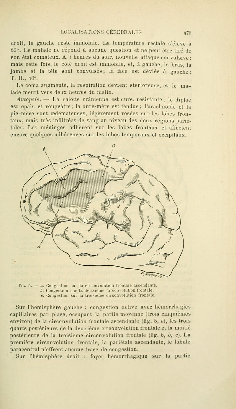 droit, le gauche reste immobile. La température rectale s'élève à 39°. Le malade ne répond à aucune question et ne peut être tiré de son état comateux. A 7 heures du soir, nouvelle attaque convulsive; mais cette fois, le côté droit est immobile, et, à gauche, le bras, la jambe et la tête sont convulsés; la face est déviée à gauche; T. R., 40°. Le coma augmente, la respiration devient stertoreuse, et le ma- lade meurt vers deux heures du matin. Autopsie. — La calotte crânienne est dure, résistante ; le diploé est épais et rougeàtre ; la dure-mère est tendue ; Tarachnoïde et la pie-mère sont œdémateuses, légèrement rosées sur les lobes fron- taux, mais très infiltrées de sang au niveau des deux régions parié- tales. Les méninges adhèrent sur les lobes frontaux et affectent encore quelques adhérences sur les lobes temporaux et occipitaux. FiG. 5. — a. Congestion sur la circonvolution frontale ascendante. b. Congestion sur la deuxième circonvolution frontale. c. Congestion sur la troisième circonvolation frontale. Sur l'hémisphère gauche : congestion active avec hémorrhagies capillaires par place, occupant la partie moyenne (trois cinquièmes environ) de la circonvolution frontale ascendante (fig. 5, a), les trois quarts postérieurs de la deuxième circonvolution frontale et la moitié postérieure de la troisième circonvolution frontale (fig. 5, b, c). La première circonvolution frontale, la pariétale ascendante, le lobule paracentral n'offrent aucune trace de congestion. Sur l'hémisphère droit : foyer hémorrhagique sur la partie
