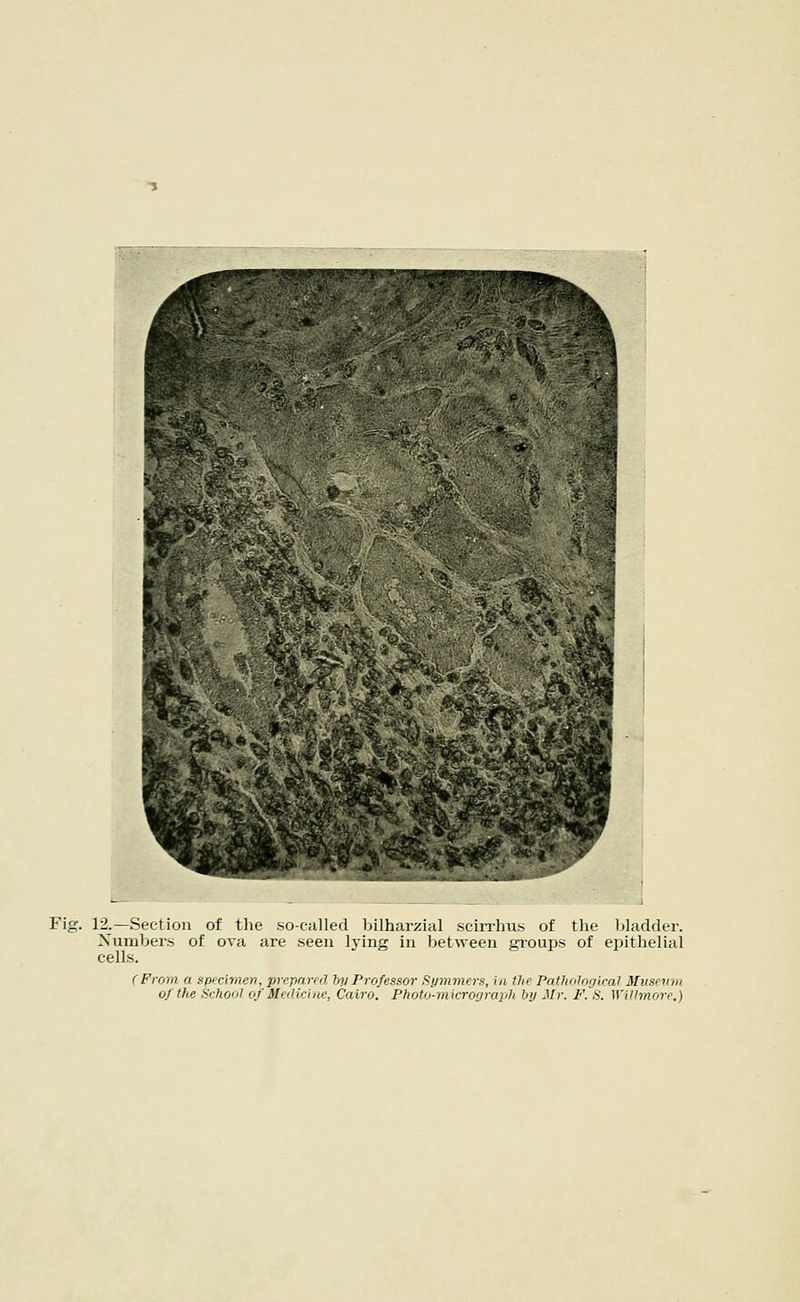 Fig. 12.—Section of the so-called bilharzial scirrhus of the bladder. Numbers of ova are seen lying in between groups of epithelial cells. (From a specimen, prepared by Professor Summers, in the Pathological Museum of the School of Medicine, Cairo. Photo-micrograph by Mr. F. S. Willmore.)