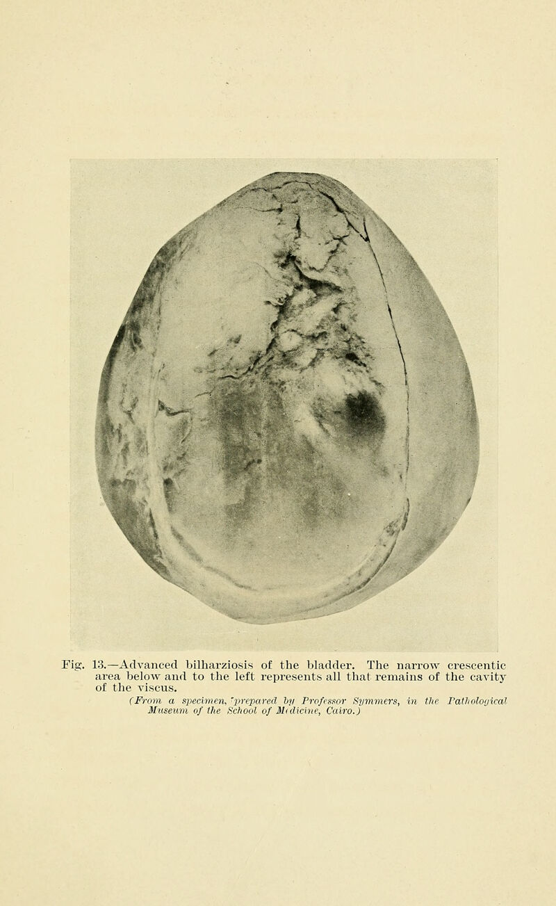 Fig. 13.—Advanced bilharziosis of the bladder. The narrow crescentic area below and to the left represents all that remains of the cavity of the viscus. (From a specimen, 'prepared by Professor Symmers, in the Pathological Museum of the School of Midicine, Cairo.)