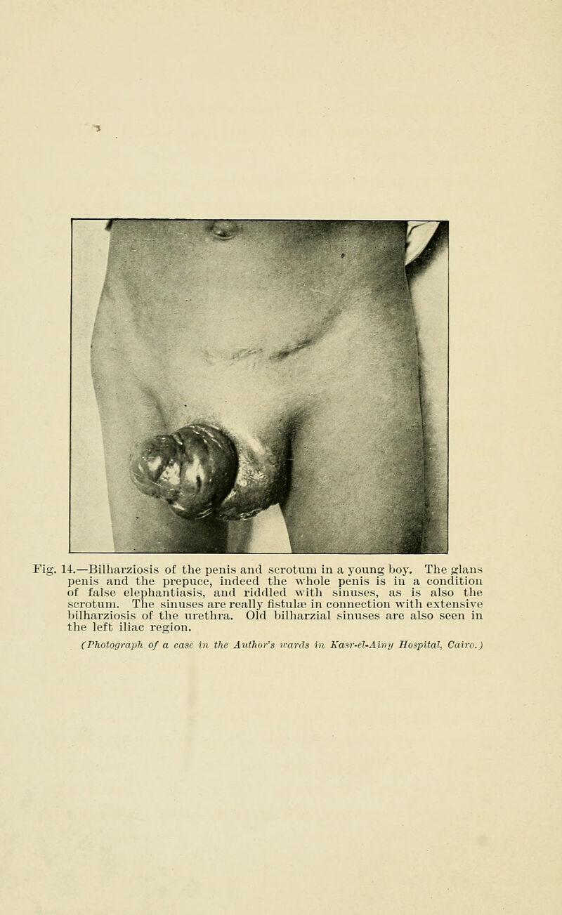 Fig. 14.—Bilharziosis of the penis and scrotum in a young boy. The glans penis and the prepuce, indeed the whole penis is in a condition of false elephantiasis, and riddled with sinuses, as is also the scrotum. The sinuses are really fistulas in connection with extensive bilharziosis of the urethra. Old bilharzial sinuses are also seen in the left iliac region. (Photograph of a case in the Author's wards in Easr-el-Avny Hospital, Cairo.)