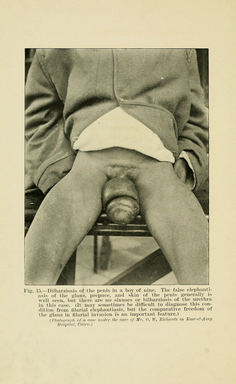 Fig. 15.—Bilharziosis of the penis in a boy of nine. The false elephanti- asis of the glans, prepuce, and skin of the penis generally is well seen, but there are no sinuses or bilhax-ziosis of the urethra in this case. (It may sometimes be difficult to diagnose this con- dition from filarial elephantiasis, but the comparative freedom of the glans in filarial invasion is an important feature.) (Photograph of a case under the care of Mr. 0. IV. Richards in Easr-rt-Ainy Hospital, Cairo.)