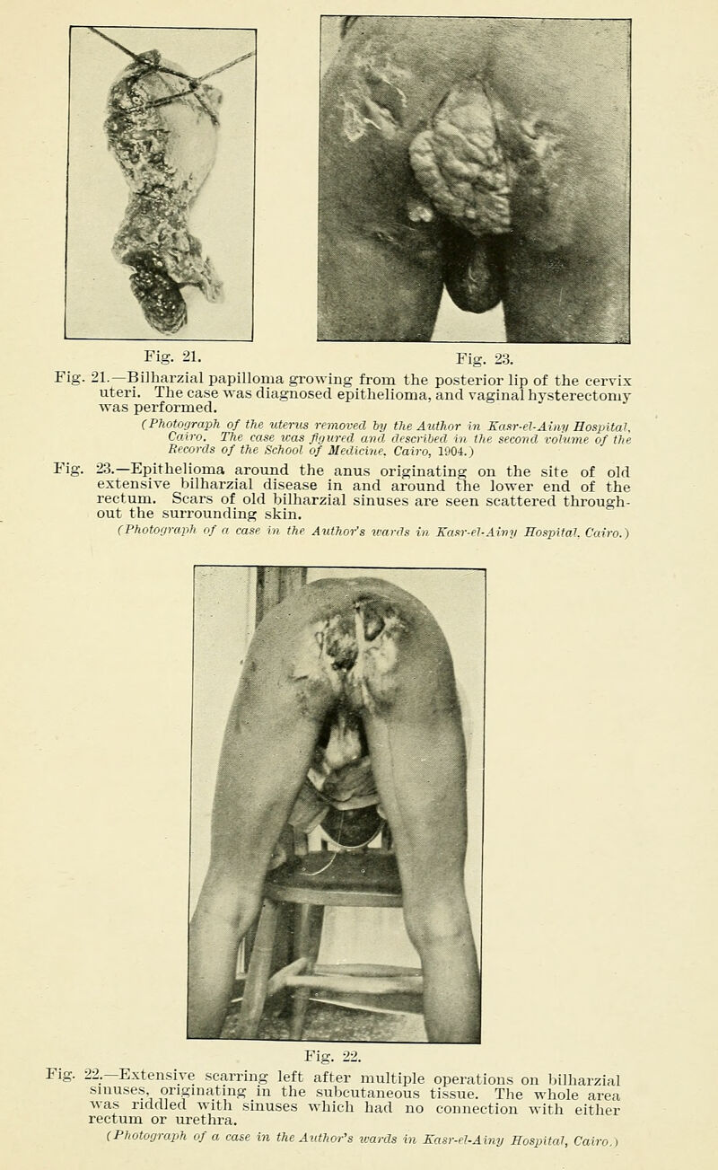 Fig. 21. Fig. 23. Fig. 21.— Bilharzial papilloma growing from the posterior lip of the cervix uteri. The case was diagnosed epithelioma, and vaginal hysterectomy was performed. (Photograph of the uterus removed by the Author in Kasr-el-Ainy Hospital, Cairo. The case icas figured and described in the second volume of the Records of the School of Medicine. Cairo, 1904.) Fig. 23.—Epithelioma around the anus originating on the site of old extensive bilharzial disease in and around the lower end of the rectum. Scars of old bilharzial sinuses are seen scattered through- out the surrounding skin. (Photograph of a case in the Author's wards in Kasr-el-Ainy Hospital, Cairo.) Fig. 22.— Extensive scarring left after multiple operations on bilharzial sinuses, originating in the subcutaneous tissue. The whole area was riddled with sinuses which had no connection with either rectum or urethra. (Photograph of a case in the Author's wards in Kasr-el-Ainy Hospital, Cairo.)