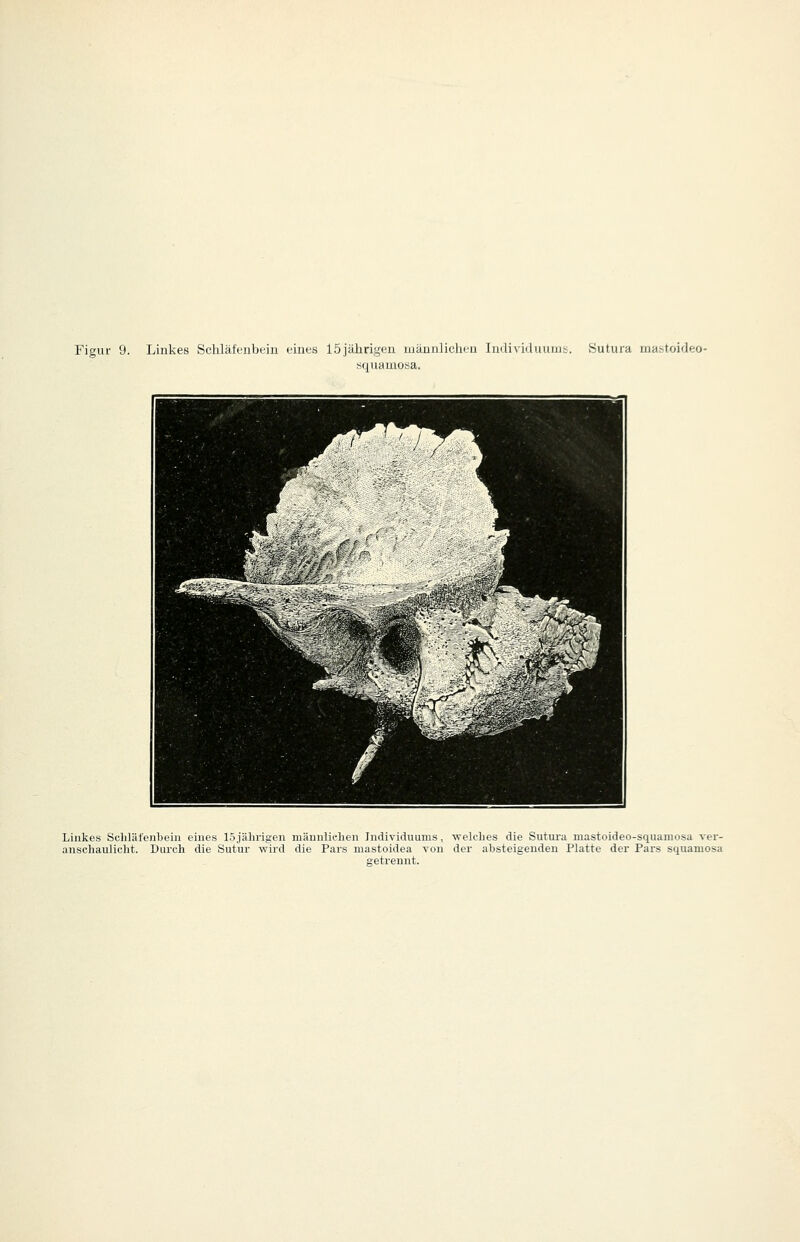 squamoüa. Linkes Schläfenbein eines 15jährigen männlichen Individuums, welches die Sutura mastoideo-squamosa ver- anschaulicht. Durch die Sutur wird die Pars mastoidea von der absteigenden Platte der Pars squamosa getrennt.