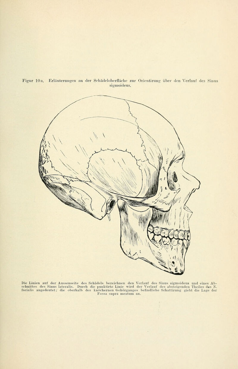 Figur 10a. Erliliiteruiigen an der Scliildelobcrfläclio zur Oricntirunf? über don N'erlauf des Sinus sigmoideus. Die Linien anf der Aussenseite des Schädels bezeichnen den Verlauf des Sinus sigmoideus und eines Ab- schnittes des Sinus lateralis. Durch die punktirte Linie wird der Verlauf des absteigenden Theiles des K. facialis angedeutet; die oberhalb des knöchernen Crehörganges befindliche Schattirung giebt die Lage der Fossa supra meatum an.