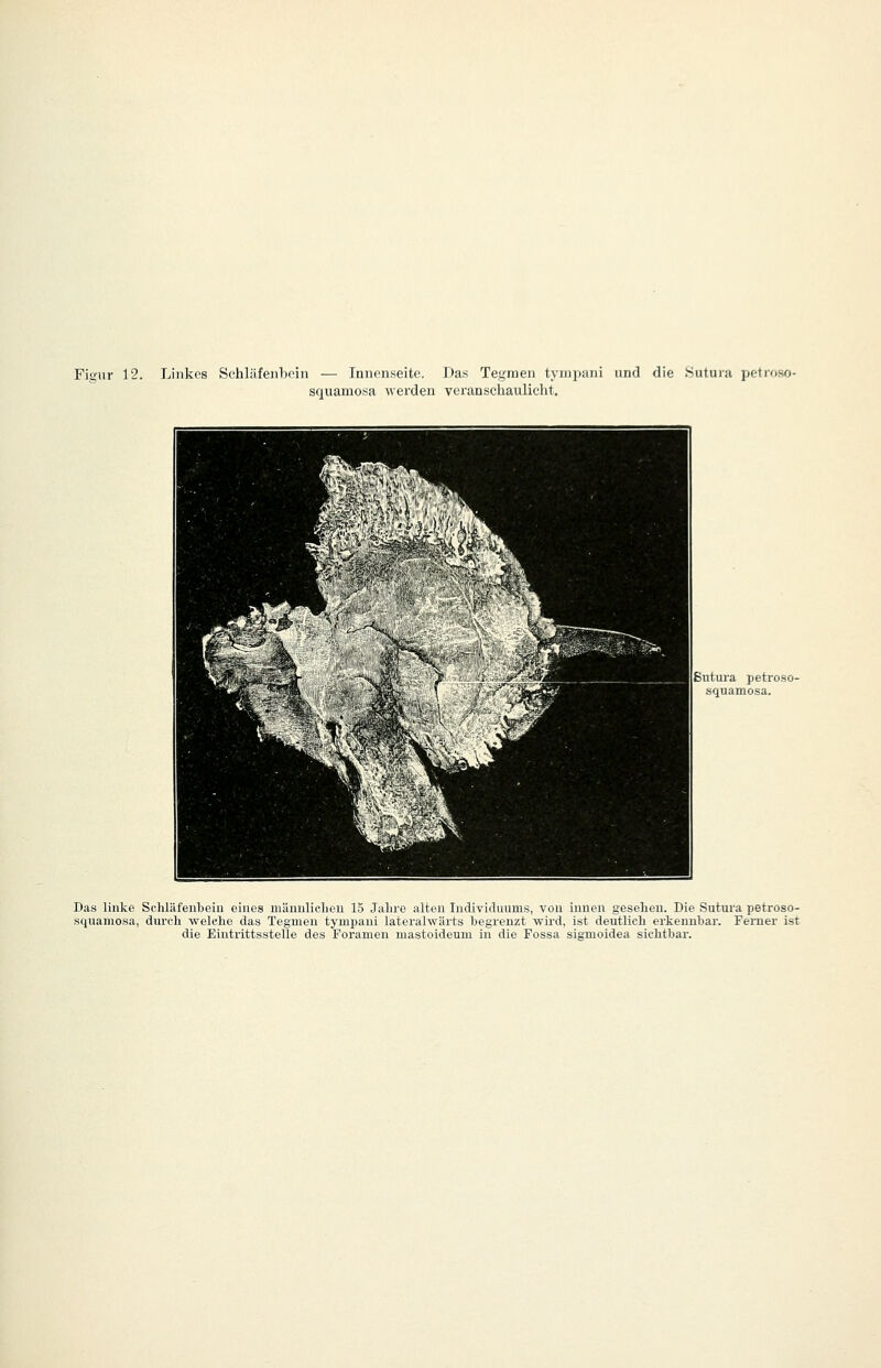 Figur 12. Linkes Schläfenbein — Innenseite. Das Tegmen tyuapani und die Sutura petroso- squamosa werden vei'anschaulicht. ppn HH ^K^^$^^ ^* ^. L« H^^^^B ^H^^^ >x^ \ WB^m ^— ^^'*''IbL'Ifc» ^»^^^I^X V^\ iPPHflBpH^PB^^H ■yi '^iilH ■H ^^K/^ «^^^^f^H ^^^HBIt! ' '^^^^^l ^^1 ■, ;; -■._' fl^H ^H^Bf ^v ''^^^^1 ^^1 E ^^1 ■^ 1 Ljb ßntura petroso- .squamosa. Das linke Schläfenbein eines männliclieu 15 Jahre alten Individimms, von innen gesehen. Die Sutui-a petroso- squamosa, durch welche das Tegmen tympani lateralwärts begrenzt wird, ist deutlich erkennbar. Ferner ist die Eintrittsstelle des Foramen mastoideum in die Fossa sigmoidea sichtbar.