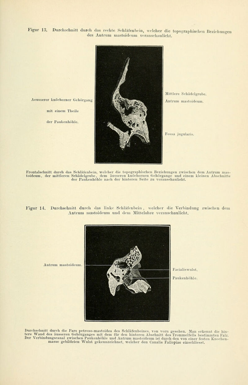 Figur 13. Durdischiiitt diircli dius ivi^lilc S.'hlälenlMin, udohcr die topoL'rajdiiHrlK-ii Hezifhuugen des Ard.nmi iiiasloidriini v<T;insi'liiiMlif;)d,. Aeusserer knöfherner Gehörgauj^ mit einem Tlieile der Paukenhölilo. ■ )k;'A''>^-V^^^^H ^^^lBii?':J99 ^^^^^^H^^HHi^'^il'J ■Ws,'!^ .-^ ^^^^^1 ^^I^HPvT f?'— ».;i^^^| ^^^^^HH^^^^^BkL* ^H^i^^^i •r.,v^;.\ -^^^H ^^^^^^^K^y. '^ ^i^^^^H ^^^mjM ■n Mittlere Scliä'lelgrube. AntriiM) ma.stoideum. Fossa jugularis. Frontalsclmitt durch das Schlärenbeiu, welcher die topographisclien Beziehungen zwischen dem Antrum mas- toideuni, der mittleren Sehädelgrube, dem äusseren knöchernen Gehörgange und einem kleinen Abschnitte der Paukenhöhle nacli der hinteren Seite zu veranschaulicht. Figur 14. Durehschiiitt durch das linke Schläfenbein , welcher die VerljinduDg zwischen dem Antrum mastoideum und dem Mittelohre veranschauliclit. Antrum mastoideum. Durchschnitt durch die Pars petroso-mastoidea des Schläfenbeines, von vorn gesehen. 3Ian erkennt die hin- tere Wand des äusseren Gehörgauges mit dem für den hinteren Abschnitt desTrommelfells bestimmten Falz. Der Verbindungscanal zwischen Paukenhöhle und Antrum mastoideum ist diuxh den von einer festen Knochen- masse gebildeten Wulst gekennzeichnet, welcher den Caualis Fallopiae einsehliesst.