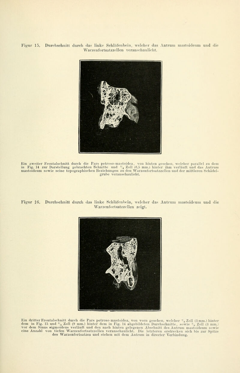 Fisiir 15. Duri'lischiiitl iliircli ilas linke Schläfenbein, welclicr das Anirum miistoidcuni und die W'a izcn fori Sil iz/.cllen vcranr^cliaiiliclit. Ein zweiter Froiit;ilschiiitt diircli die Pars petroso-mastoidea, von Junten gesehen, welciier parallel zu dem in Fig. 14 zur Darstellung gebrachten Seimitte und ^'4 Zoll (6,5 mm.) hinter ihm verläuft und das Antruni mastoideum sowie seine topographischen Beziehungen zu den Warzenfortsatzzellen und der mittleren üehädel- gmbe veranschaulicht. Figur 16. Durchschnitt durch das liniie Schläfenbein, welcher das Antruui mastoideum und die Warzenfortsatzzellen zeigt. ^^S^J Hü IH ^^^^1 ^^^HH ^'' SL^'^.^^II Hr '' Hh^H ^^^^^B^r i^^lH Ein di-itter Frontalschnitt durch die Tars petroso-mastoidea, von vorn gesehen, welcher ' , ZoU (3 mm.1 hinter dem in Fig. 15 und '« Zoll (9 mm.) hinter dem in Fig. l-t abgebildeten Durchschnitte, sowie '^ Zoll (3 mm.) vor dem Sinus sigmoideus verläuft und den nach hinten gelegenen Abschnitt des Autnim mastoideum sowie eine Anzahl von tiefen Warzenfortsatzzellen veranschaulicht. Die letzteren erstrecken sich bis zur Spitze des Warzenfortsatzes und stehen mit dem Autrum in directer Verbindung.