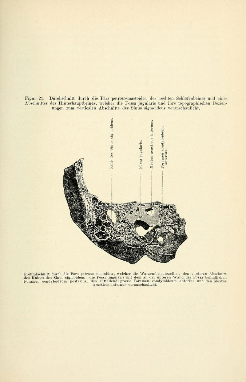 Figur 21. Durchschnitt durch die Pars petroso-mastoidea des rechten Schläfenbeines und eines Abschnittes des Hinterliauptl)eines, welclier die Fossa jugularis und ihre toiiographischen Eezieh- ungen zum verticalen Abschnitte des Sinus signioidcus veranschaulicht. Froutalsehnitt durch die Pars petroso-mastoidea, weleher die Warzeufortsatzzelleu, den vorderen Abschnitt des Kuiees des Sinus sigmoideus, die Fossa jugularis mit dem an der unteren Wand der Fossa befindliehen Forameu condyloideum posterius, das auffallend grosse Foramen condyloideum anterius und den 3Ieatus acusticus internus veranschaulicht.