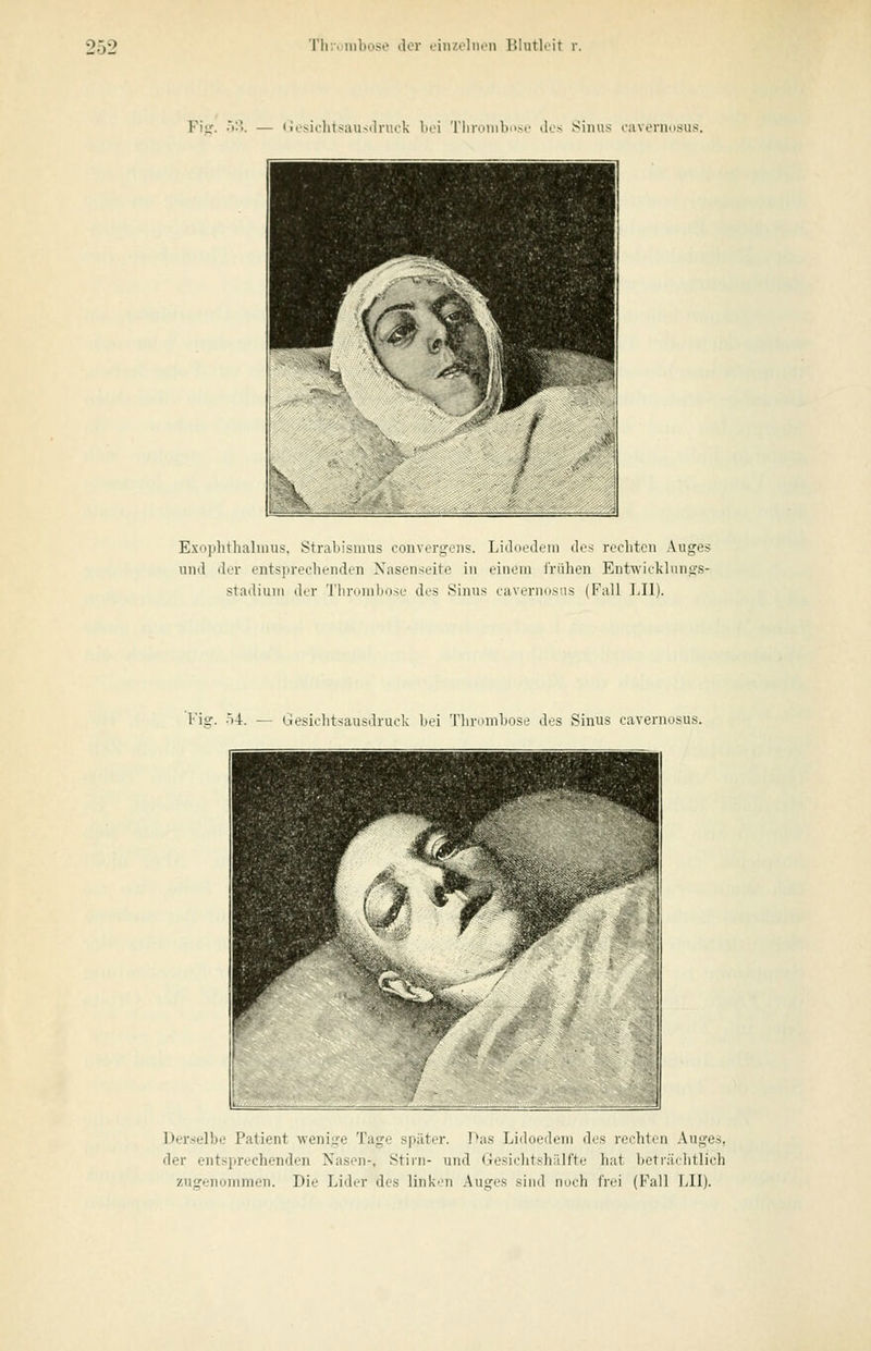 Fi- Gesichtsausilniek Ihm 'riiroinbosi' dos Sinus lavcninsiis. Exophthalmus. Strabismus convergoiis. Liduodcin des rccbten Auges und di'v entsiireebeiiden Nasenseite in einem l'rühen Entwirkluns-s- stadium der 'J'lirumbose des Sinus cavernosus (Fall LH). l'iir. Ö4. Gesichtsausdruck bei Tlirombose des Sinus cavernosus. Derselbe Patient wenige Tage später. Pas Lidoedem des rechten Auges, der entsprechenden Nasen-, Stirn- und (je.sichtshälfte hat beti'äditlich zugenommen. Die Lider des linken Auges sind noch frei (Fall LH).