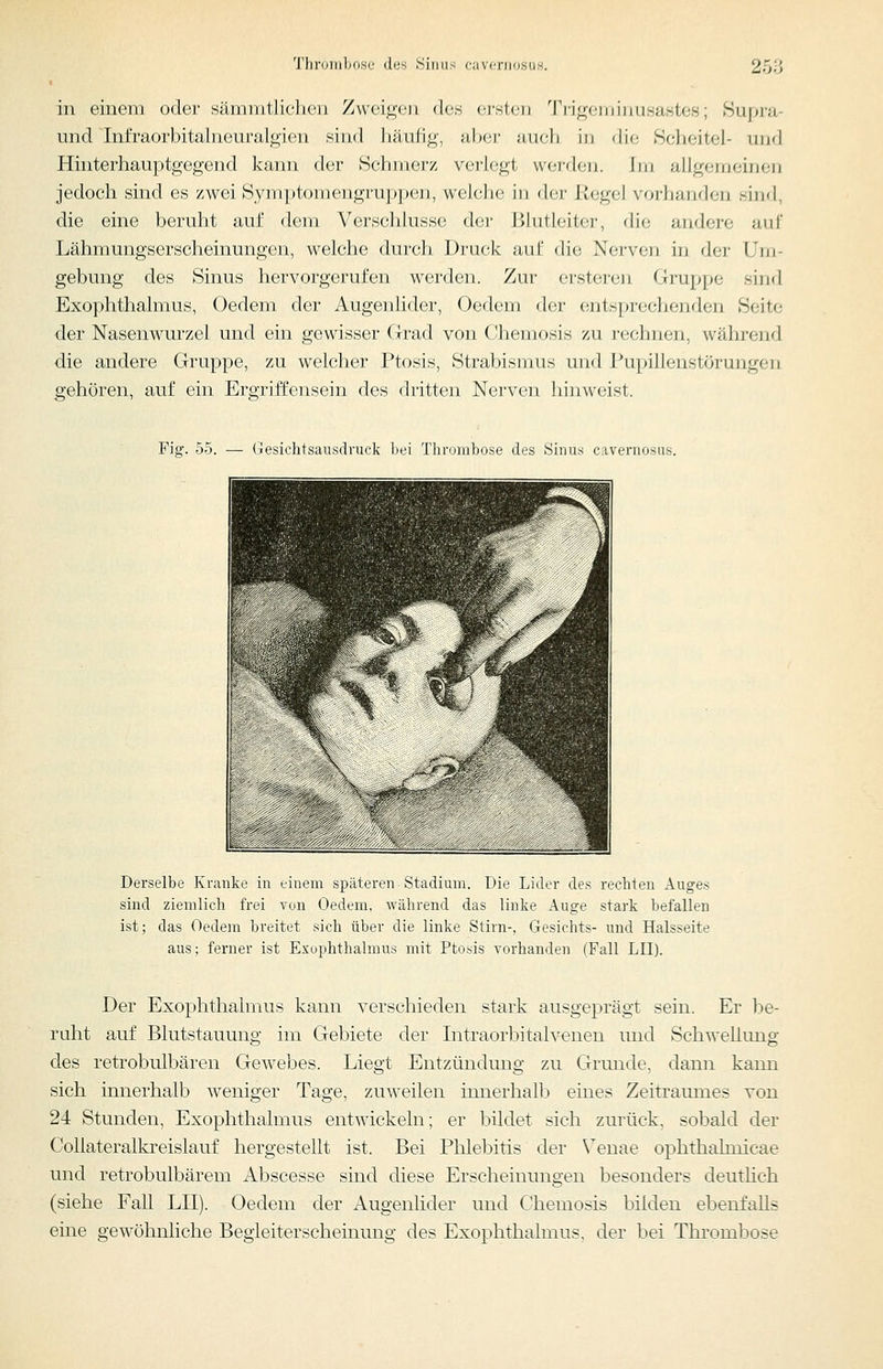 in einem oder sämnitliclieii Zwci^-cji dos ei'stcn Tiij^cMiiiiiusastos; Supm- und Infraorbitalneuralgien sind häufig, aber auch in die Scheitel- und Hiuterhauptgegend kann der Schmerz verlegt werden, im allgemeinen jedoch sind es zwei Sym])tomengru|)i)en, welche in der Kegel vorhanden sind, die eine beruht auf dem Verschlusse der Blutleiter, die andere auf Lähmungserscheinungen, welche durch Druck auf die Nerven in der Um- gebung des Sinus hervorgerufen werden. Zur ersteren Gruppe sind Exophthalmus, Oedem der Augenlider, Oedcm der entspreclienden Seite der Nasenwurzel und ein gewisser Grad von Chemosis zu rechnen, während die andere Gruppe, zu welcher Ptosis, Strabismus und Pupillenstörungen gehören, auf ein Ergriffensein des dritten Nerven Jiinweist. Fig. 55. — Gesichtsausdrufk liei Thrombose des .Sirius cavernosus. Derselbe Kranke in einem späteren Stadium. Die Lider des rechten Auges sind ziemlich frei von Oedem. während das linke Auge stark befallen ist; das Oedem breitet sich über die linke Stirn-, Gesichts- und Halsseite aus; ferner ist Exophthalmus mit Ptosis vorhanden (Fall LH). Der Exophthalmus kann verschieden stark ausgeprägt sein. Er he- ruht auf Blutstauung im Gebiete der Intraorbitalvenen und Schwellung des retrobulbären Gewebes. Liegt Entzündung zu Grunde, dann kann sich innerhalb weniger Tage, zuweilen innerhalb eines Zeitraumes von 24 Stunden, Exophthalmus entwickeln; er bildet sich zurück, sobald der Collateralkreislauf hergestellt ist. Bei Phlebitis der \euae ophthalmicae und retrobulbärem Abscesse sind diese Erscheinungen besonders deutlich (siehe Fall LH). Oedem der Augenlider und Chemosis bilden ebenfalls eine gewöhnliche Begleiterscheinung des Exophthalmus, der bei Thrombose