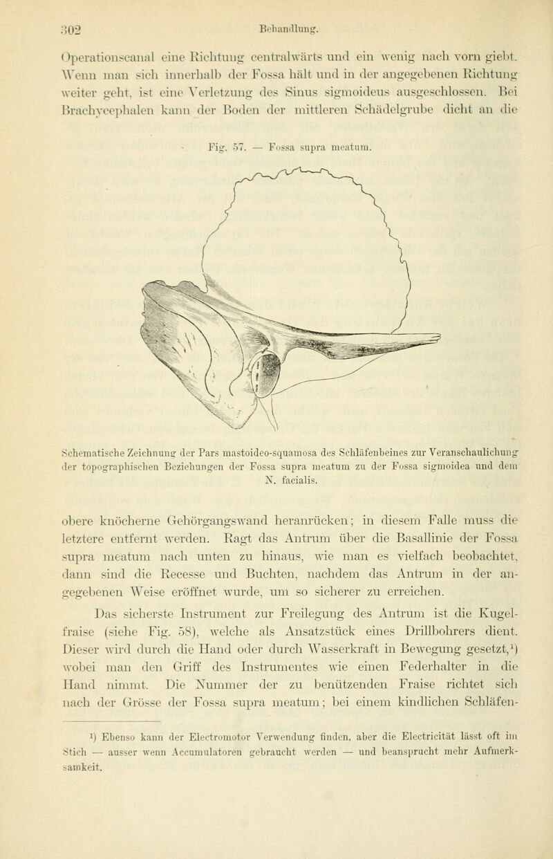 Operationscanal eine Richtuug centralwärts und ein w eni_o- nach vorn giebt. AVenu mau sich innerhalb der Fossa häU und in der anoeoebeneu Riclituno; weiter geht, ist eine ^\n•let7AUlg des Sinus sigmoideus ausgeöchlossen. l^ei Brachyeephalen kann der Boden der mittleren Schädelgrube dicht an die Fig. 57. — Fossa supra iiu'atuni. Schematische Zeichiiuns: der Pars mastoideo-squamosa des Schläfenbeines zur Veranschaulichung- der topographischen Beziehungen der Fossa supra ineatum zu der Fossa sigmoidea und dem N. facialis. obere knöcherne Gehörgangswand heranrücken; in diesem Falle muss die letztere entfernt werden. Ragt das Antrum über die Basallinie der Fossa supra meatum nach unten zu hinaus, wie man es vielfach beobachtet, dann sind die Recesse und Buchten, nachdem das Antrum in der an- gegebenen Weise eröffnet wurde, um so sicherer zu erreichen. Das sicherste Instrument zur Freilegung des Antrum ist die Kugel- fraise (siehe Fig. 58), welche als Ansatzstück eines Drillbohrers dient. Dieser wird durch die Hand o<loi' durch Wasserkraft in Bewegmig gesetzt,^) wobei man den Griff des Instrumentes wde einen Federhalter in die Hand nimmt. Die Nummer der zu benützenden Fraise richtet sich nach der Grösse der Fossa supra meatum; bei einem kindhchen Schlafen- 1) Ebenso kann der Electromotor Verwendung finden, aber die Electricität lässt oft im Stich — ausser wenn Accuniulatoren gebraucht werden — und beansprucht mehr Aufmerk- samkeit.