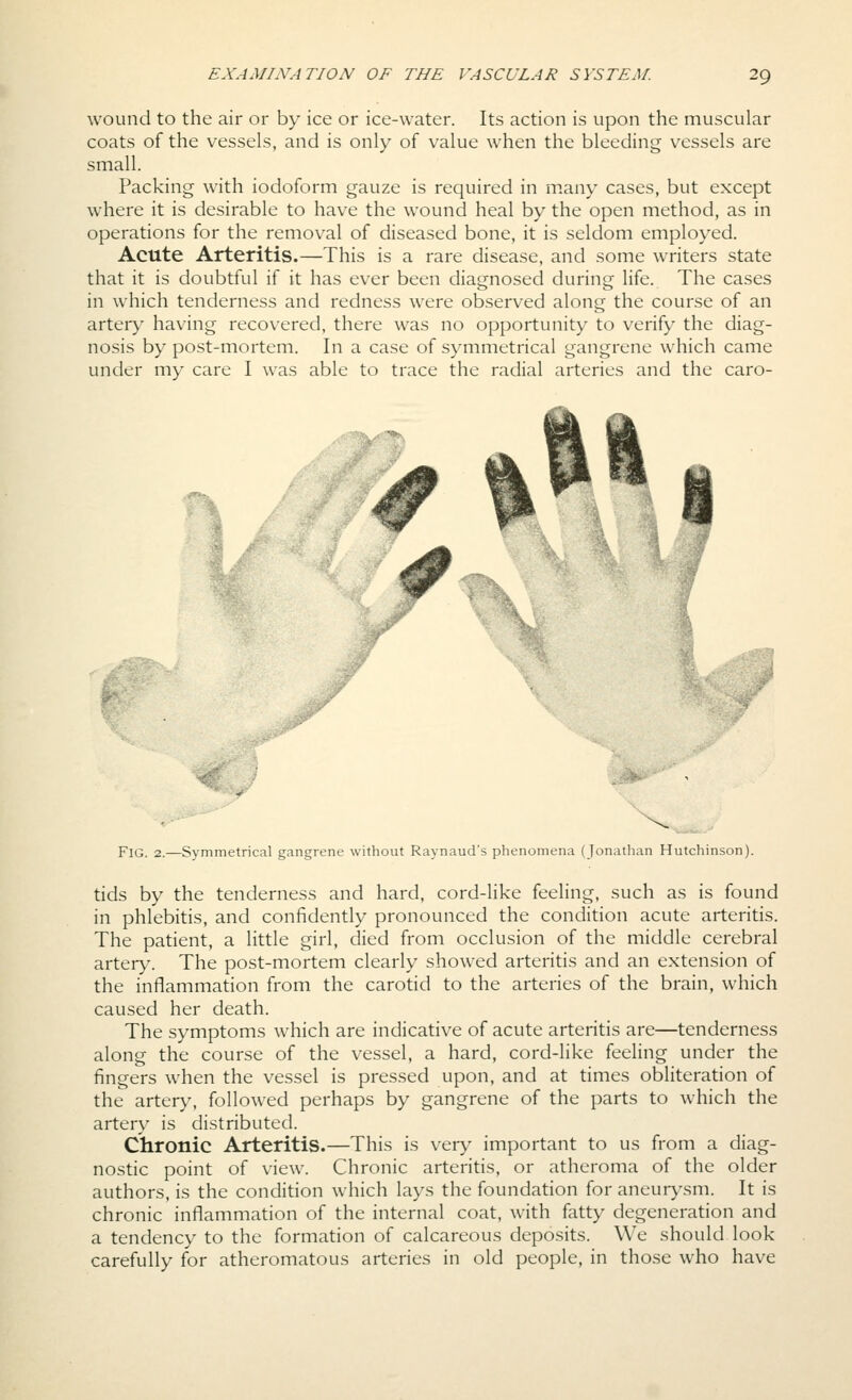 wound to the air or by ice or ice-water. Its action is upon the muscular coats of the vessels, and is only of value when the bleeding vessels are small. Packing with iodoform gauze is required in niany cases, but except where it is desirable to have the wound heal by the open method, as in operations for the removal of diseased bone, it is seldom employed. Acute Arteritis.—This is a rare disease, and some writers state that it is doubtful if it has ever been diagnosed during life. The cases in which tenderness and redness were observed along the course of an artery having recovered, there was no opportunity to verify the diag- nosis by post-mortem. In a case of symmetrical gangrene which came under my care I was able to trace the radial arteries and the caro- ^^^' J Fig. 2.—Symmetrical gangrene without Raynaud's phenomena (Jonatlian Hutchinson). tids by the tenderness and hard, cord-like feeling, such as is found in phlebitis, and confidently pronounced the condition acute arteritis. The patient, a little girl, died from occlusion of the middle cerebral artery. The post-mortem clearly showed arteritis and an extension of the inflammation from the carotid to the arteries of the brain, which caused her death. The symptoms which are indicative of acute arteritis are—tenderness along the course of the vessel, a hard, cord-like feeling under the fingers when the vessel is pressed upon, and at times obliteration of the artery, followed perhaps by gangrene of the parts to which the artery is distributed. Chronic Arteritis.—This is very important to us from a diag- nostic point of view. Chronic arteritis, or atheroma of the older authors, is the condition which lays the foundation for aneur>^sm. It is chronic inflammation of the internal coat, with fatty degeneration and a tendency to the formation of calcareous deposits. We should look carefully for atheromatous arteries in old people, in those who have