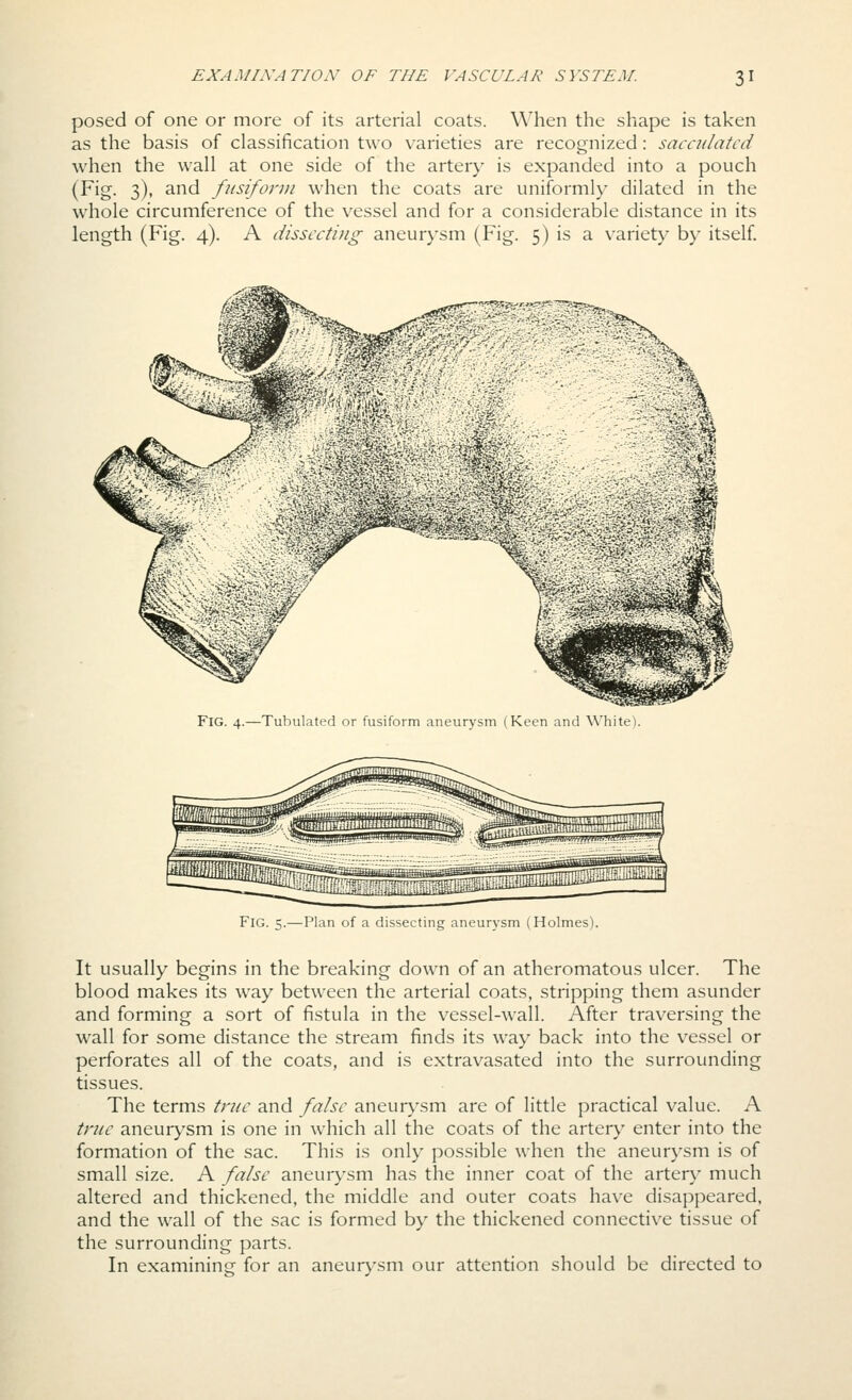 posed of one or more of its arterial coats. When the shape is taken as the basis of classification two varieties are recognized: sacculated when the wall at one side of the arter>' is expanded into a pouch (Fig. 3), and fusiform when the coats are uniformly dilated in the whole circumference of the vessel and for a considerable distance in its length (Fig. 4). A dissecting aneurysm (Fig. 5) is a variety by itself Fig. 4.—Tubulated or fusiform aneurysm (Keen and White). Fig. 5.—Plan of a dissecting aneurysm (Holmes). It usually begins in the breaking down of an atheromatous ulcer. The blood makes its way between the arterial coats, stripping them asunder and forming a sort of fistula in the v^essel-wall. After traversing the wall for some distance the stream finds its way back into the vessel or perforates all of the coats, and is extravasated into the surrounding tissues. The terms true and false aneur}^sm are of little practical value. A true aneurysm is one in which all the coats of the artery enter into the formation of the sac. This is only possible when the aneurysm is of small size. A false aneurysm has the inner coat of the arten,^ much altered and thickened, the middle and outer coats have disappeared, and the wall of the sac is formed by the thickened connective tissue of the surrounding parts. In examining for an aneur\'sm our attention should be directed to