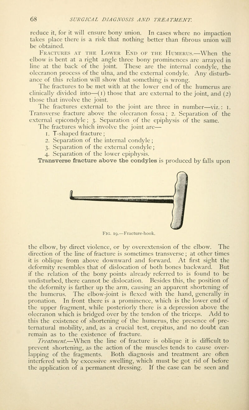 reduce it, for it will ensure bony union. In cases where no impaction takes place there is a risk that nothing better than fibrous union will be obtained. Fractures at thp: Lowkr End of the Humerus.—When the elbow is bent at a right angle three bony prominences are arrayed in hne at the back of the joint. These are the internal cond)'lc, the olecranon process of the ulna, and the external condyle. Any disturb- ance of this relation will show that something is wrong. The fractures to be met with at the lower end of the humerus are clinically divided into—(i) those that are external to the joint, and (2) those that involve the joint. The fractures external to the joint are three in number—viz.: i. Transverse fracture above the olecranon fossa; 2. Separation of the external epicondyle; 3. Separation of the epiphysis of the same. The fractures which involve the joint are— 1. T-shaped fracture; 2. Separation of the internal condyle; 3. Separation of the external condyle; 4. Separation of the lower epiphysis. Transverse fracture above the condyles is produced by falls upon Fig. 19.—Fracture-hook. the elbow, by direct violence, or by overextension of the elbow. The direction of the line of fracture is sometimes transverse; at other times it is oblique from above downward and forward. At first sight the deformity resembles that of dislocation of both bones backward. But if the relation of the bony points already referred to is found to be undisturbed, there cannot be dislocation. Besides this, the position of the deformity is farther up the arm, causing an apparent shortening of the humerus. The elbow-joint is flexed with the hand, generally in pronation. In front there is a prominence, which is the lower end of the upper fragment, while posteriorly there is a depression above the olecranon which is bridged over by the tendon of the triceps. Add to this the existence of shortening of the humerus, the presence of pre- ternatural mobility, and, as a crucial test, crepitus, and no doubt can remain as to the existence of fracture. Treatment.—When the line of fracture is oblique it is difficult to prevent shortening, as the action of the muscles tends to cause over- lapping of the fragments. Both diagnosis and treatment are often interfered with by excessive swelling, which must be got rid of before the application of a permanent dressing. If the case can be seen and