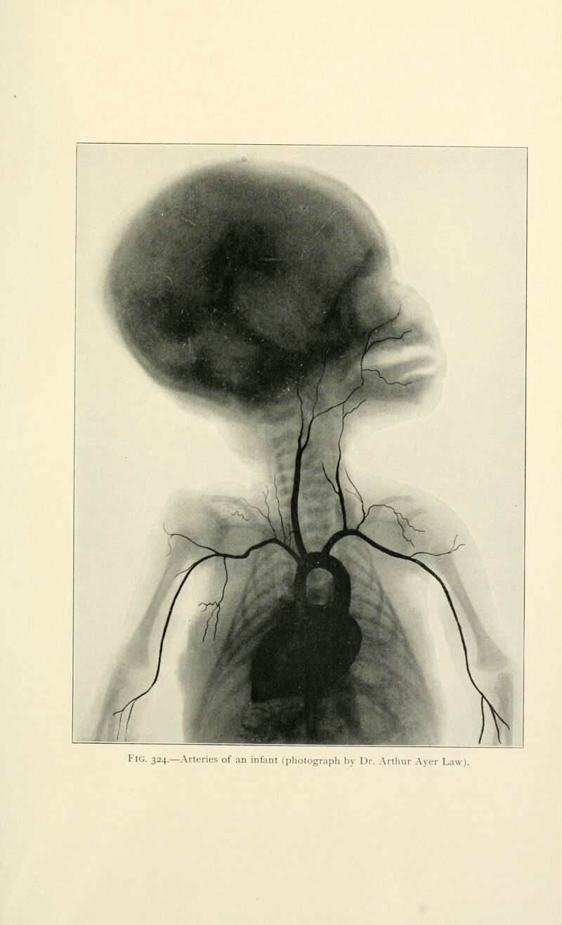 Fig. 324.—Arteries of an infant (pliotograph by Dr. Artlnir Ayer Law).