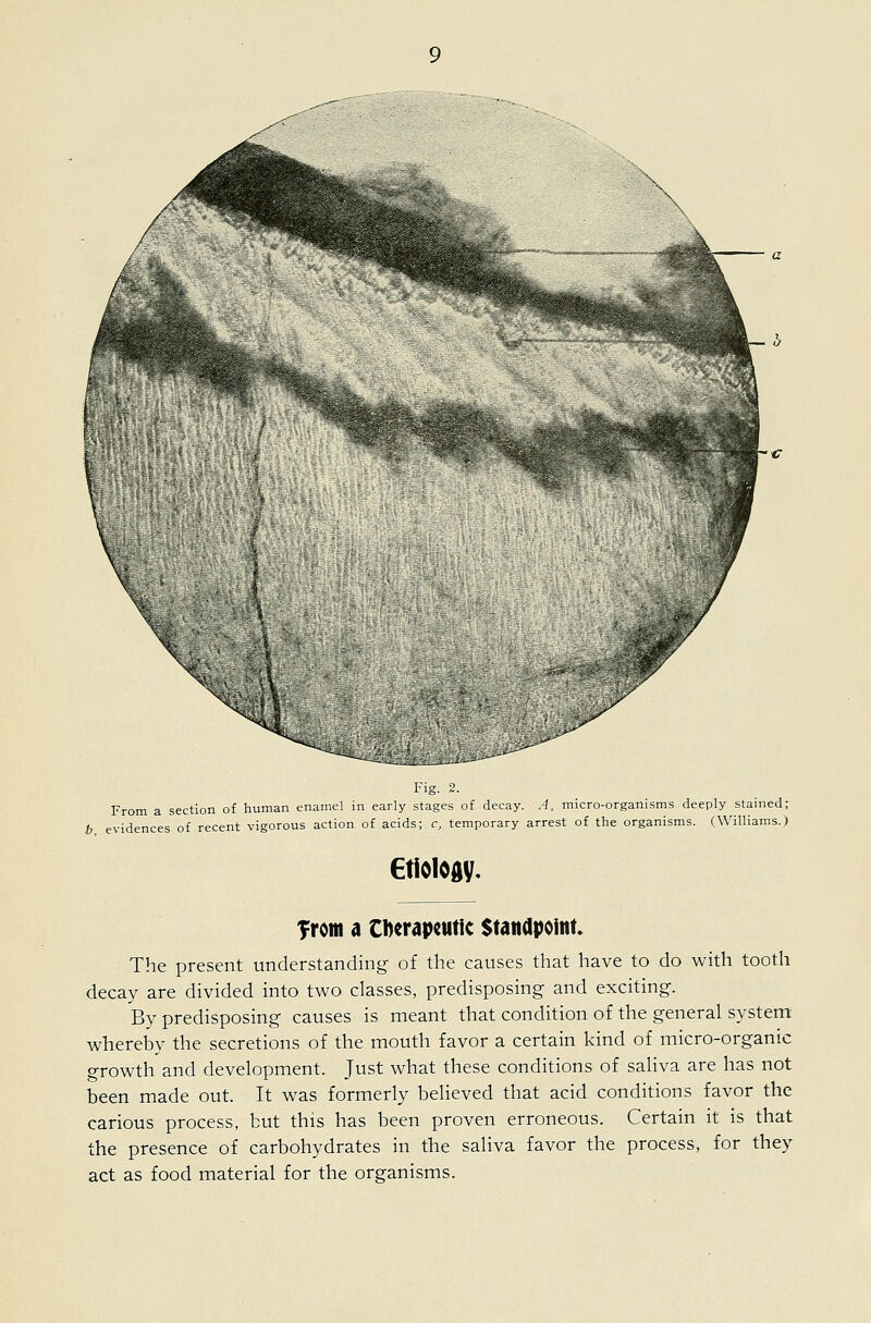 y Fig. 2. From a section of human enamel in early stages of decay. A, micro-organisms deeply stained; b evidences of recent vigorous action of acids; c, temporary arrest of the organisms. (Williams.) etiology. Trom a Cberapcutic Standpoint The present understanding of the causes that have to do with tooth decay are divided into two classes, predisposing and exciting. By predisposing causes is meant that condition of the general system whereby the secretions of the mouth favor a certain kind of micro-organic growth and development. Just what these conditions of saliva are has not been made out. It was formerly believed that acid conditions favor the carious process, but this has been proven erroneous. Certain it is that the presence of carbohydrates in the saliva favor the process, for they act as food material for the organisms.