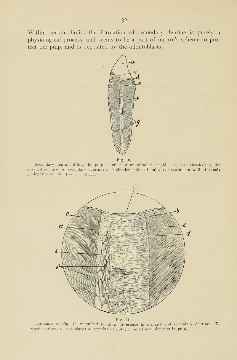 Within certain limits the formation of secondary dentine is purely a physiological process, and seems to be a part of nature's scheme to pro- tect the pulp, and is deposited by the odontoblasts. Fig. 10. Secondary dentine filling the pulp cliamber of an abraded cuspid. A, part abraded; c, the abraded surface; rf, secondary dentine; <?, a slender point of pulp; f, deposits on wall of canal;. g, deposits in pulp tissue. (Black.) FiR. 11. The same as Fig. 10—magnified to show difference in primary and secondary dentine. D, normal dentine; b, secondary; e, remains of pulp; /, small oval deposits in pulp.