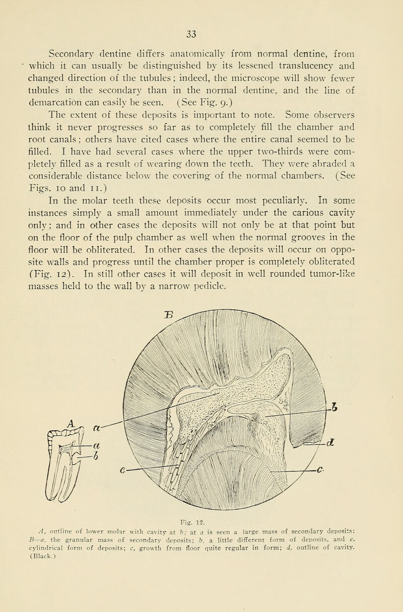 Secondary dentine differs anatomically from normal dentine, from Avhich it can usually be distinguished by its lessened translucency and changed direction of the tubules; indeed, the microscope will show fewer tubules in the secondary than in the normal dentine, and the line of demarcation can easily be seen. (See Fig. 9.) The extent of these deposits is important to note. Some observers think it never progresses so far as to completeh' fill the chamber and root canals ; others have cited cases where the entire canal seemed to be filled. I have had several cases where the upper two-thirds were com- pletely filled as a result of wearing down the teeth. They were abraded a considerable distance below the covering of the normal chambers. (See Figs. 10 and 11.) In the molar teeth these deposits occur most peculiarly. In some instances sim.ph' a small amount immediately under the carious cavity only; and in other cases the deposits wall not only be at that point but on the floor of the pulp chamber as w^ell when the normal grooves in the floor will be obliterated. In other cases the deposits will occur on oppo- site walls and progress until the chamber proper is completely obliterated CFig. 12). In still other cases it will deposit in well rounded tumor-like masses held to the wall by a narrow pedicle. Fig. 12. A, outline of lower molar with cavity at h: at a is seen a large mass of secondary deposit's: B—a, the granular mass of secondary deposits; h, a little different form of deposits, and e, cylindrical form of deposits; c, growth from floor quite regular in form; d, outline of cavity. (Black.)