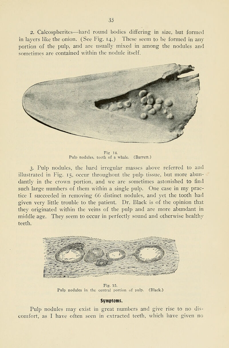2. Calcospherites—hard round bodies differing in size, but formed in layers like the onion. (See Fig. 14.) These seem to be formed in any portion of the pulp, and are usually mixed in among the nodules and sometimes are contained within the nodule itself. Pulp nodules, tooth of a whale. (Barrett.) 3. Pulp nodules, the hard irregular masses above referred to and illustrated in Fig. 15, occur throughout the pulp tissue, but more abun- dantly in the crown portion, and we are sometimes astonished to find such large numbers of them within a single pulp. One case in my prac- tice I succeeded in removing 66 distinct nodules, and yet the tooth had given very little trouble to the patient. Dr. Black is of the opinion that they originated within the veins of the pulp and are more abundant in middle age. They seem to occur in perfectly sound and otherwise healthy teeth. -^.^V^^-^V-^SJi^Vv X Fig. 15. Pulp nodules in the central portion of pulp. (Black.) Symptoms. Pulp nodules may exist in great numbers and give rise to no dis- comfort, as I have often seen in extracted teeth, which have given no