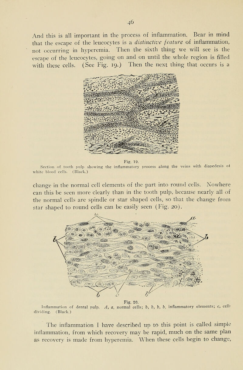 And this is all important in the process of inflammation. Bear in mind that the escape of the leucocytes is a distinctive feature of inflammation, not occurring in hyperemia. Then the sixth thing we will see is the escape of the leucocytes, going on and on until the whole region is filled with these cells. (See Fig. 19.) Then the next thing that occurs is a Fig. 19. Section of tooth pulp showing the inflammatory process along the veins with diapedesis ot white blood cells. (Black.) change in the normal cell elements of the part into round cells. Nowhere can this be seen more clearly than in the tooth pulp, because nearly all of the normal cells are spindle or star shaped cells, so that the change from star shaped to round cells can be easily seen (Fig. 20). Fig. SO. Inflammation of dental pulp. A, a, normal cells; b, h, b, b, inflammatory elements; c, cell? dividing. (Black.) The inflammation I have described up to this point is called simple inflammation, from which recovery may be rapid, much on the same plan as recovery is made from hyperemia. When these cells begin to change.
