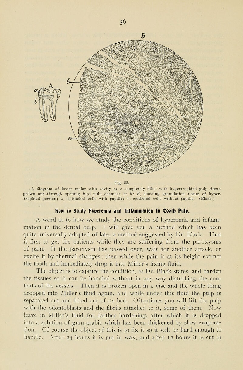 Fig. 23. A, diagram of lower molar with cavity at a completely filled with hypertrophied pulp tissue grown out through opening into pulp chamber at b; B, showing granulation tissue of hyper- trophied portion; a, epithelial cells with papilla; h, epithelial cells without papilla. (Black.) 1>ow to study 1>yperemia ana Tnflammation Tn tooth Pulp. A word as to how we study the conditions of hyperemia and inflam- mation in the dental pulp. I will give you a method which has been quite universally adopted of late, a method suggested by Dr. Black. That is first to get the patients wliile they are sufifering from the paroxysms of pain. If the paroxysm has passed over, wait for another attack, or excite it by thermal changes; then while the pain is at its height extract the tooth and immediately drop it into Miller's fixing fluid. The object is to capture the condition, as Dr, Black states, and harden the tissues so it can be handled without in any way disturbing the con- tents of the vessels. Then it is broken open in a vise and the whole thing dropped into Miller's fluid again, and while under this fluid the pulp is separated out and lifted out of its bed. Oftentimes you will lift the pulp with the odontoblasts' and the fibrils attached to it, some of them. Now leave in Miller's fluid for farther hardening, after which it is dropped into a solution of gum arable which has been thickened by slow evapora- tion. Of course the object of this is to fix it so it will be hard enough to handle. After 24 hours it is put in wax, and after 12 hours it is cut in
