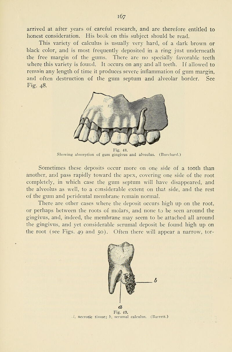 arrived at after years of careful research, and are therefore entitled to honest consideration. His book on this subject should be read. This variety of calculus is usually very hard, of a dark brown or black color, and is most frequently deposited in a ring just underneath the free margin of the gums. There are no specially favorable teeth where this variety is found. It occurs on any and all teeth. If allowed to remain any length of time it produces severe inflammation of gum margin, and often destruction of the gum septum and alveolar border. See Fig. 48. Fig. 48. Showing absorption of gum gingivus and alveolus. (Burchard.) Sometimes these deposits occur more on one side of a tooth than another, and pass rapidly toward the apex, covering one side of the root completely, in which case the gum septum will have disappeared, and the alveolus as well, to a considerable extent on that side, and the rest of the gum and peridental membrane remain normal. There are other cases where the deposit occurs high up on the root, or perhaps between the roots of molars, and none to be seen around the gingivus, and, indeed, the membrane may seem to be attached all around the gingivus, and yet considerable serumal deposit be found high up on the root (see Figs. 49 and 50). Often there will appear a narrow, tor- a Fig. 49. necrotic tissue; h, serumal calculus. (Barrett.)