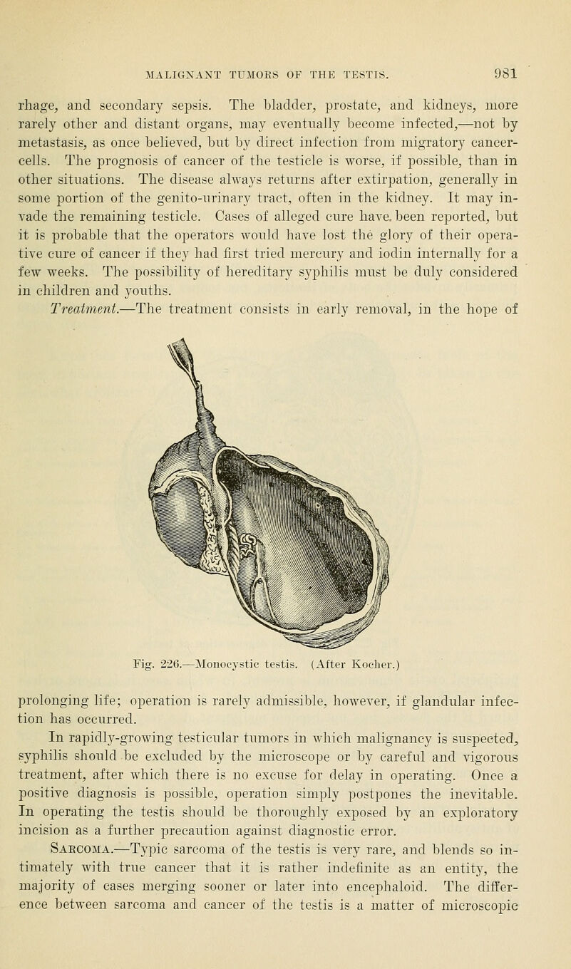 rliage, and secondary sepsis. The bladder, prostate, and kidneys, more rarely other and distant organs, may eventually become infected,—not by metastasis, as once believed, but by direct infection from migratory cancer- cells. The prognosis of cancer of the testicle is worse, if possible, than in other situations. The disease always returns after extirpation, generally in some portion of the genito-urinary tract, often in the kidney. It may in- vade the remaining testicle. Cases of alleged cure have, been reported, but it is probable that the operators would have lost the glory of their opera- tive cure of cancer if they had first tried mercury and iodin internally for a few weeks. The possibility of hereditary syphilis must be duly considered in children and youths. Treatment.—The treatment consists in early removal, in the hope of Fig. 226.—Monocystic testis. (After Kocher.) prolonging life; operation is rarely admissible, however, if glandular infec- tion has occurred. In rapidly-growing testicular tumors in which malignancy is suspected, syphilis should be excluded by the microscope or by careful and vigorous treatment, after which there is no excuse for delay in operating. Once a positive diagnosis is possible, operation simply postpones the inevitable. In operating the testis should be thoroughly exposed by an exploratory incision as a further precaution against diagnostic error. Saecoma.—Typic sarcoma of the testis is very rare, and blends so in- timately with true cancer that it is rather indefinite as an entity, the majority of cases merging sooner or later into encephaloid. The differ- ence between sarcoma and cancer of the testis is a matter of microscopic