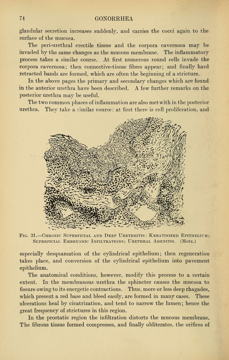glandular secretion increases suddenly, and carries the cocci again to the surface of the mucosa. The peri-urethral erectile tissue and the corpora cavernosa may be invaded by the same changes as the mucous membrane. The inflammatory process takes a similar course. At first numerous round cells invade the corpora cavernosa; then connective-tissue fibres appear; and finally hard retracted bands are formed, which are often the beginning of a stricture. In the above pages the primary and secondary changes which are found in the anterior urethra have been described. A few further remarks on the posterior urethra may be useful. The two common phases of inflammation are also met with in the posterior urethra. They take a similar course: at first there is cell proliferation, and Fig. 31.—Chronic Superficial and Deep Urethritis: Keratinized Epithelium; Superficial Embryonic Infiltrations; Urethral Adenitis. (Motz.) especially desquamation of the cylindrical epithelium; then regeneration takes place, and conversion of the cylindrical epithelium into pavement epithelium. The anatomical conditions, however, modify this process to a certain extent. In the membranous urethra the sphincter causes the mucosa to fissure owing to its energetic contractions. Thus, more or less deep rhagades, which present a red base and bleed easily, are formed in many cases. These ulcerations heal by cicatrization, and tend to narrow the lumen; hence the great frequency of strictures in this region. In the prostatic region the infiltration distorts the mucous membrane. The fibrous tissue formed compresses, and finally obliterates, the orifices of