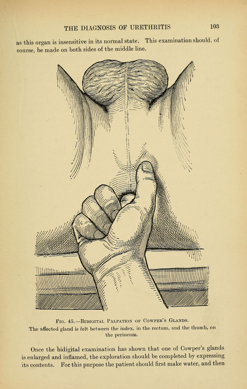 as this organ is insensitive in its normal state. This examination should, of course, be made on both sides of the middle line. Fig. 45.—Bidigital Palpation of Cowper's Glands. The affected gland is felt between the index, in the rectum, and the thumb, on the perineum. Once the 'bidigital examination has shown that one of Cowper's glands is enlarged and inflamed, the exploration should be completed by expressing its contents. For this purpose the patient should first make water, and then