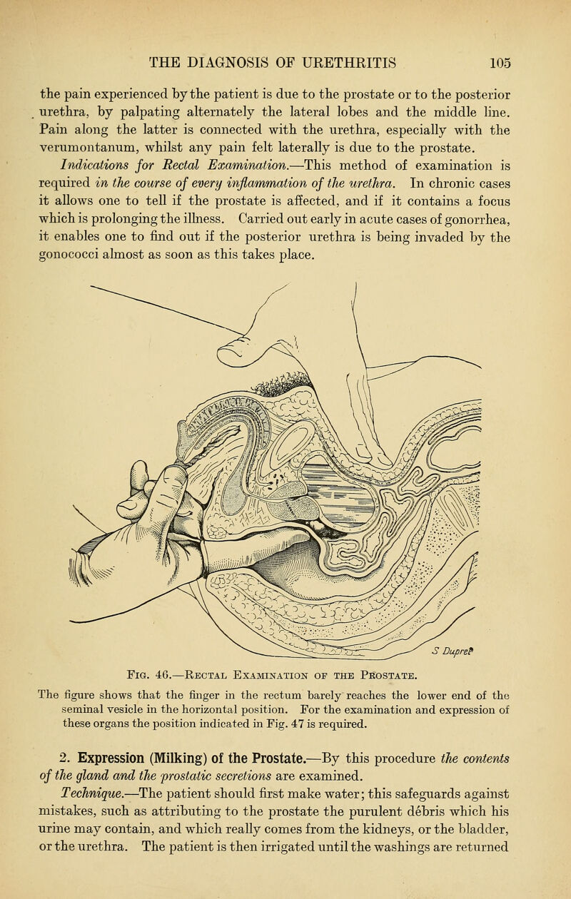 the pain experienced by the patient is due to the prostate or to the posterior urethra, by palpating alternately the lateral lobes and the middle line. Pain along the latter is connected with the urethra, especially with the verumontanum, whilst any pain felt laterally is due to the prostate. Indications for Rectal Examination.—This method of examination is required in the course of every inflammation of the urethra. In chronic cases it allows one to tell if the prostate is afTected, and if it contains a focus which is prolonging the illness. Carried out early in acute cases of gonorrhea, it enables one to find out if the posterior urethra is being invaded by the gonococci almost as soon as this takes place. Fig. 46.—Rectal ExAMiNATioisr of the Prostate. The figure shows that the finger in the rectum barely reaches the lower end of the seminal vesicle in the horizontal position. For the examination and expression of these organs the position indicated in Fig. 47 is required. 2. Expression (Milking) of the Prostate.—By this procedure the contents of the gland and the 'prostatic secretions are examined. Technique.—The patient should first make water; this safeguards against mistakes, such as attributing to the prostate the purulent debris which his urine may contain, and which really comes from the kidneys, or the bladder, or the urethra. The patient is then irrigated until the washings are returned