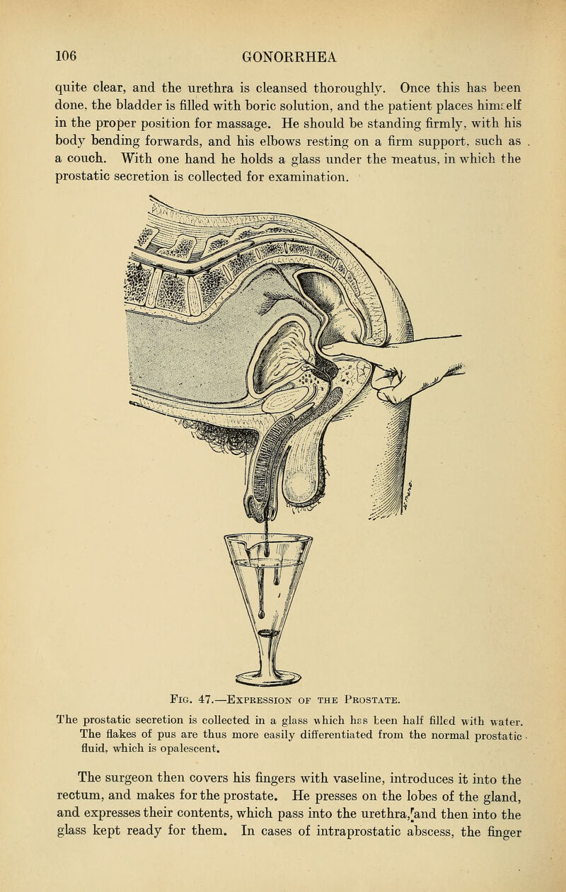 quite clear, and the urethra is cleansed thoroughly. Once this has been done, the bladder is filled with boric solution, and the patient places himcelf in the proper position for massage. He should be standing firmly, with his body bending forwards, and his elbows resting on a firm support, such as a couch. With one hand he holds a glass under the meatus, in which the prostatic secretion is collected for examination. Fig. 47.—Expbession of the Prostate. The prostatic secretion is collected, in a glass \vhich has teen half filled with water. The flakes of pus are thus more easily differentiated from the normal prostatic fluid, which is opalescent. The surgeon then covers his fingers with vaseline, introduces it into the rectum, and makes for the prostate. He presses on the lobes of the gland, and expresses their contents, which pass into the urethra,[and then into the glass kept ready for them. In cases of intraprostatic abscess, the finger