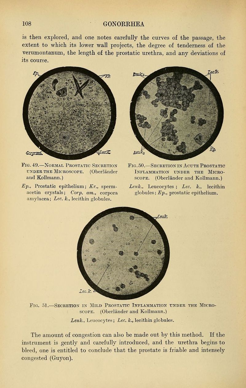 is then explored, and one notes carefully the curves of the passage, the extent to which its lower wall projects, the degree of tenderness of the verumontanum, the length of the prostatic urethra, and any deviations of its course. Fig. 49.—Normal Prostatic Secretion UNDER THE MICROSCOPE. (Oberlander and KoUmann.) Ef., Prostatic epithelium; Kr., sperm- acetin crystals; Corp. am., corpora amylacea; Lee. k., lecithin globules. Fig. 50.—Secretion in Acute Prostatic Inflammation under the Micro- scope. (Oberlander and Kollmann.) Leuk., Leucocytes ; Lee. k., lecithin globules; Ep., prostatic epithelium. Fig. 51. -Secretion in Mild Prostatic Inflammation under the Micro- scope. (Oberlander and Kollmann.) Leuk., Leucocytes; Lee. k., lecithin globules. The amount of congestion can also be made out by this method. If the instrument is gently and carefully introduced, and the urethra begins to bleed, one is entitled to conclude that the prostate is friable and intensely congested (Guyon).