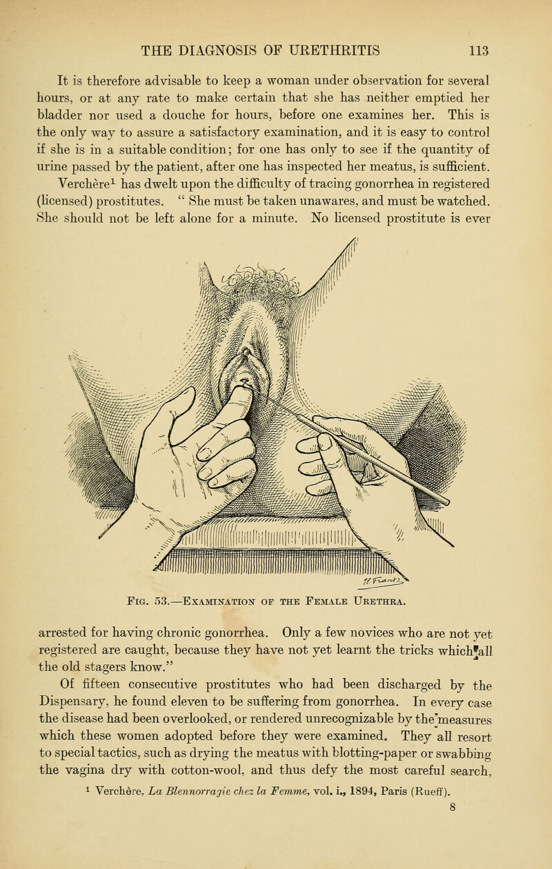 It is therefore advisable to keep a woman under observation for several hours, or at any rate to make certain that she has neither emptied her bladder nor used a douche for hours, before one examines her. This is the only way to assure a satisfactory examination, and it is easy to control if she is in a suitable condition; for one has only to see if the quantity of urine passed by the patient, after one has inspected her meatus, is suflScient. Verchere^ has dwelt upon the difl&culty of tracing gonorrhea in registered (licensed) prostitutes.  She must be taken unawares, and must be watched. She should not be left alone for a minute. No licensed prostitute is ever Fig. 53.—ExAivnNATioi^ of the Female Urethra. arrested for having chronic gonorrhea. Only a few novices who are not yet registered are caught, because they have not yet learnt the tricks whichfall the old stagers know. Of fifteen consecutive prostitutes who had been discharged by the Dispensary, he found eleven to be suffering from gonorrhea. In every case the disease had been overlooked, or rendered unrecognizable by the'measures which these women adopted before they were examined. They all resort to special tactics, such as drying the meatus with blotting-paper or swabbing the vagina dry with cotton-wool, and thus defy the most careful search, 1 Verchdre, La Blennorragie chez la Femme, vol. i., 1894, Paris (Rueff).