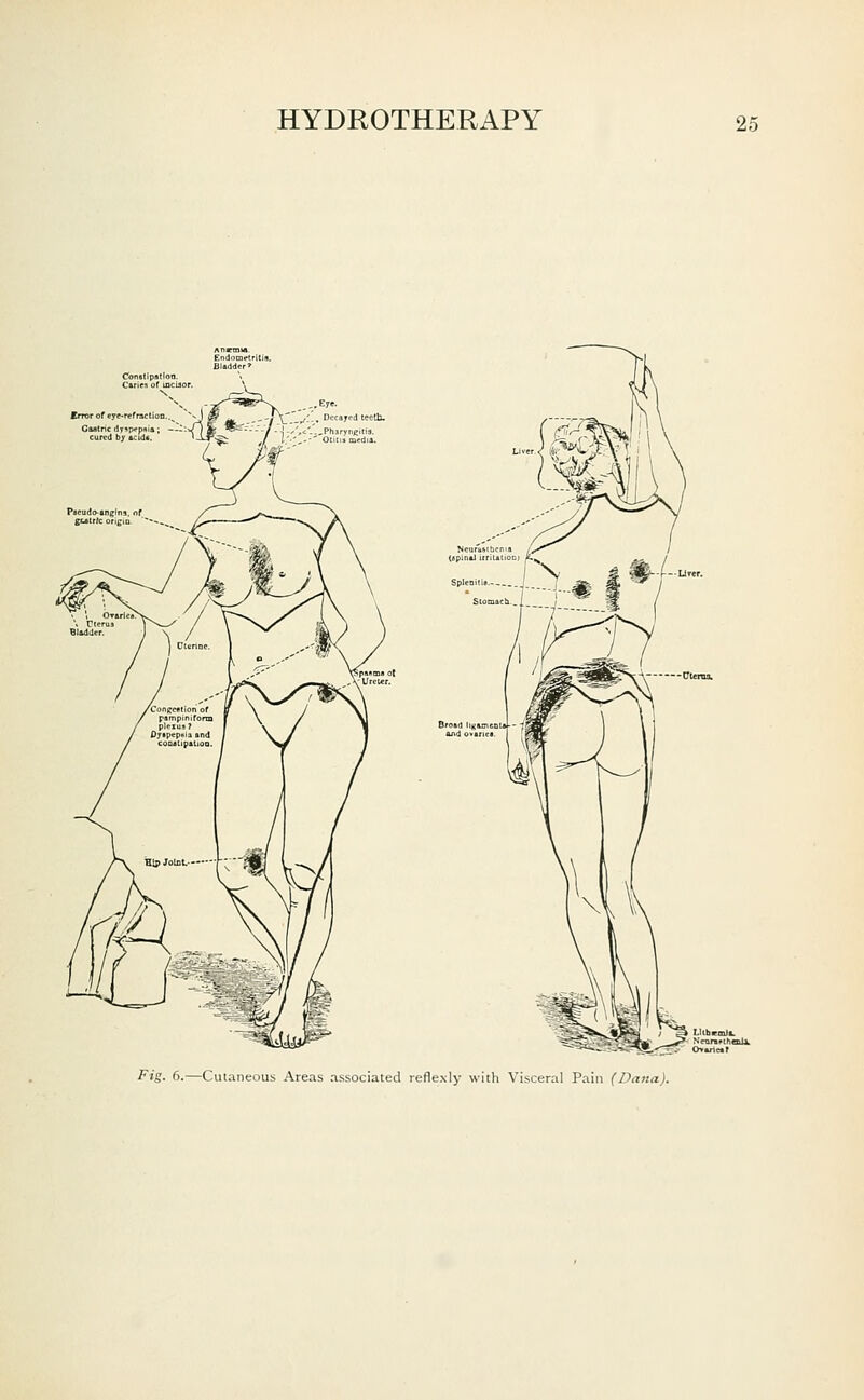 Error of eyt-refracli Gutric dr^p^pnia Dccajod teetb. Fig. 6.—Cut:ineous Areas associated reflexly with Visceral Pain (Dana),